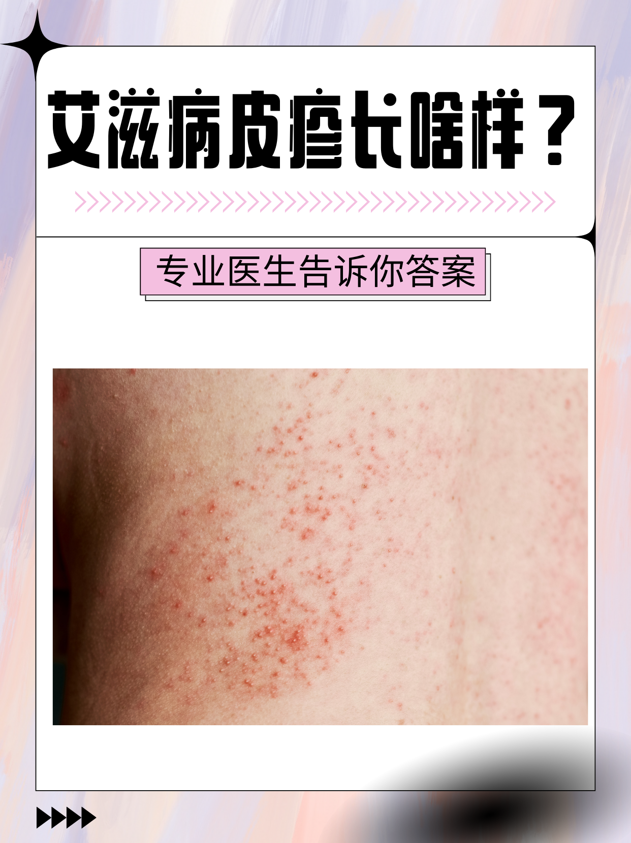 艾滋病皮疹,作为艾滋病病毒感染人体后的一种皮肤表现,是艾滋病病程