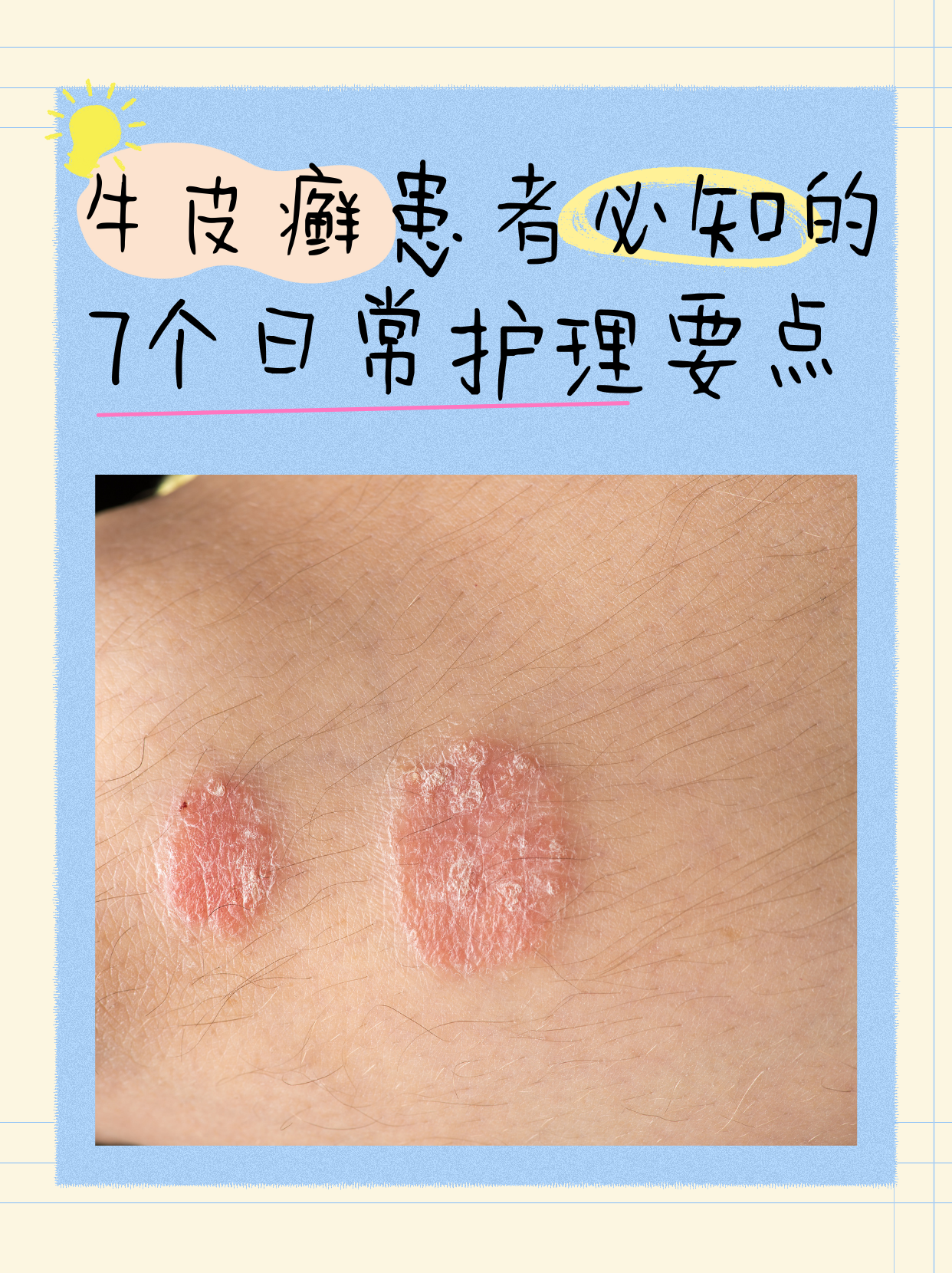 牛皮癣患者必知的7个日常护理要点