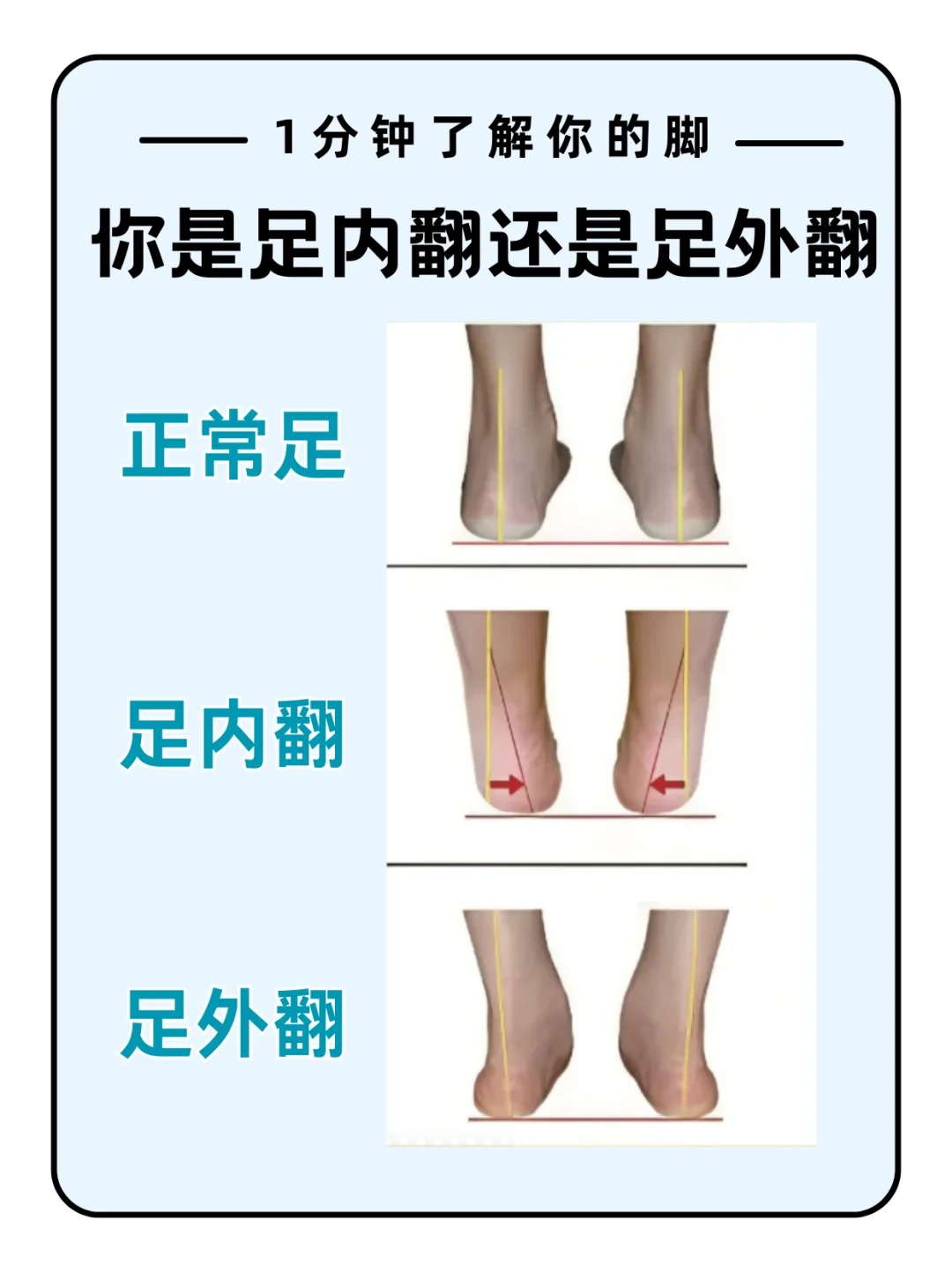 一岁半宝宝足外翻图片