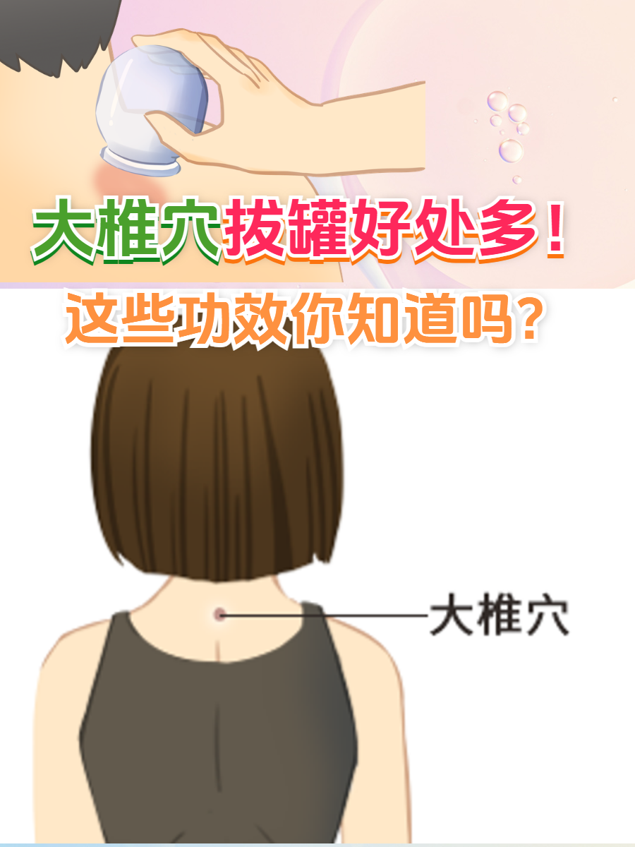 疏风解表,缓解感冒症状 大椎穴属督脉,与阳气运行颈椎拔罐的正确位 