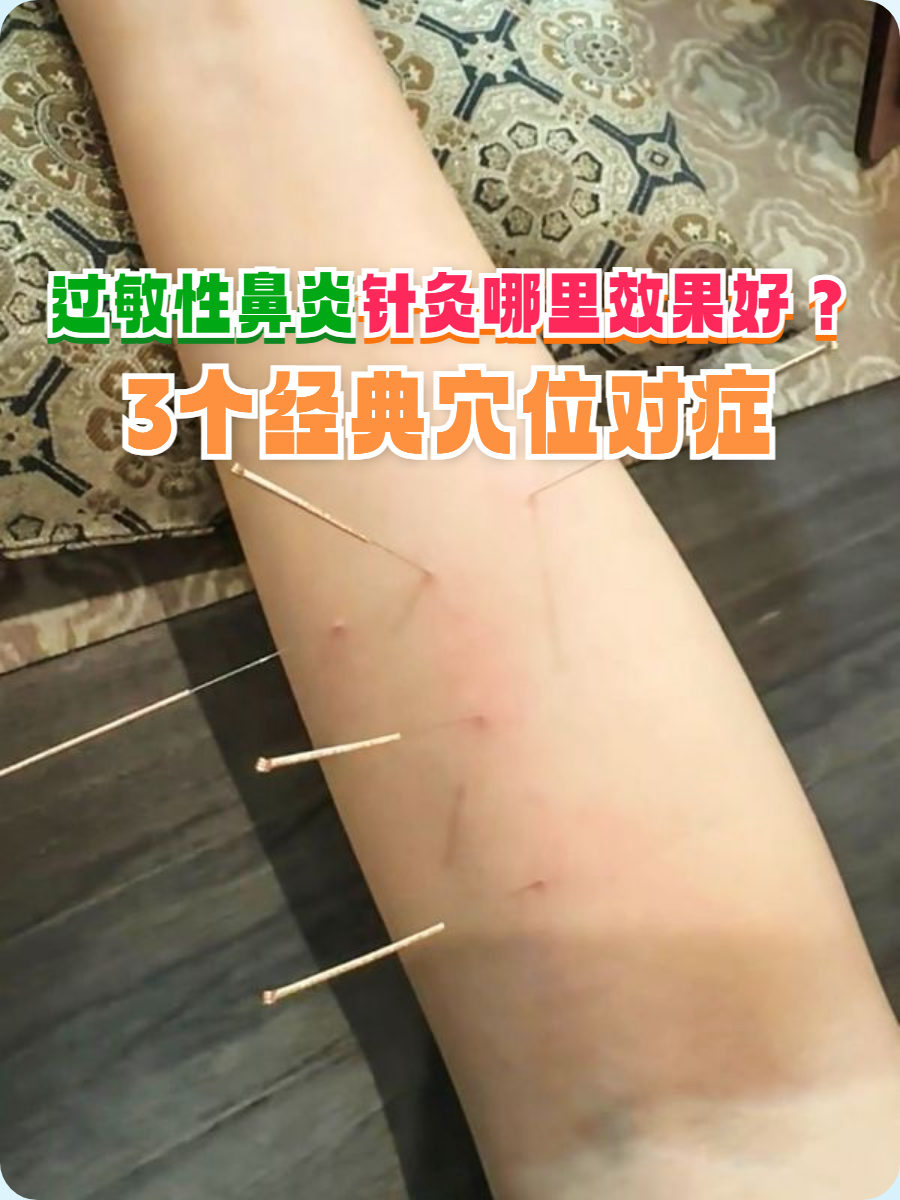 过敏性鼻炎常伴随鼻塞,打喷嚏,流清涕,反复发作时