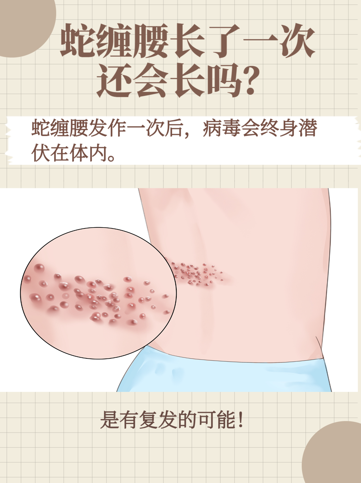 蛇缠腰复发有3个方面的原因: