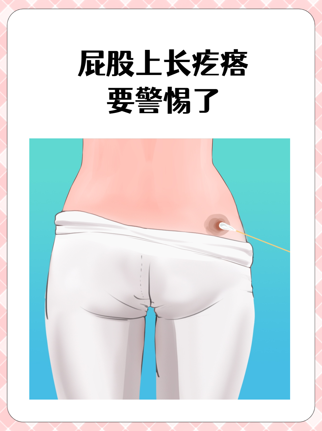 屁股上长疙瘩要警惕了