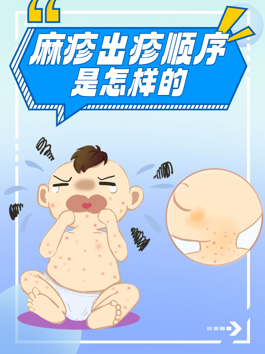 你了解吗  麻疹是一种由麻疹病毒引起的急性呼吸道传染病,对于儿童的