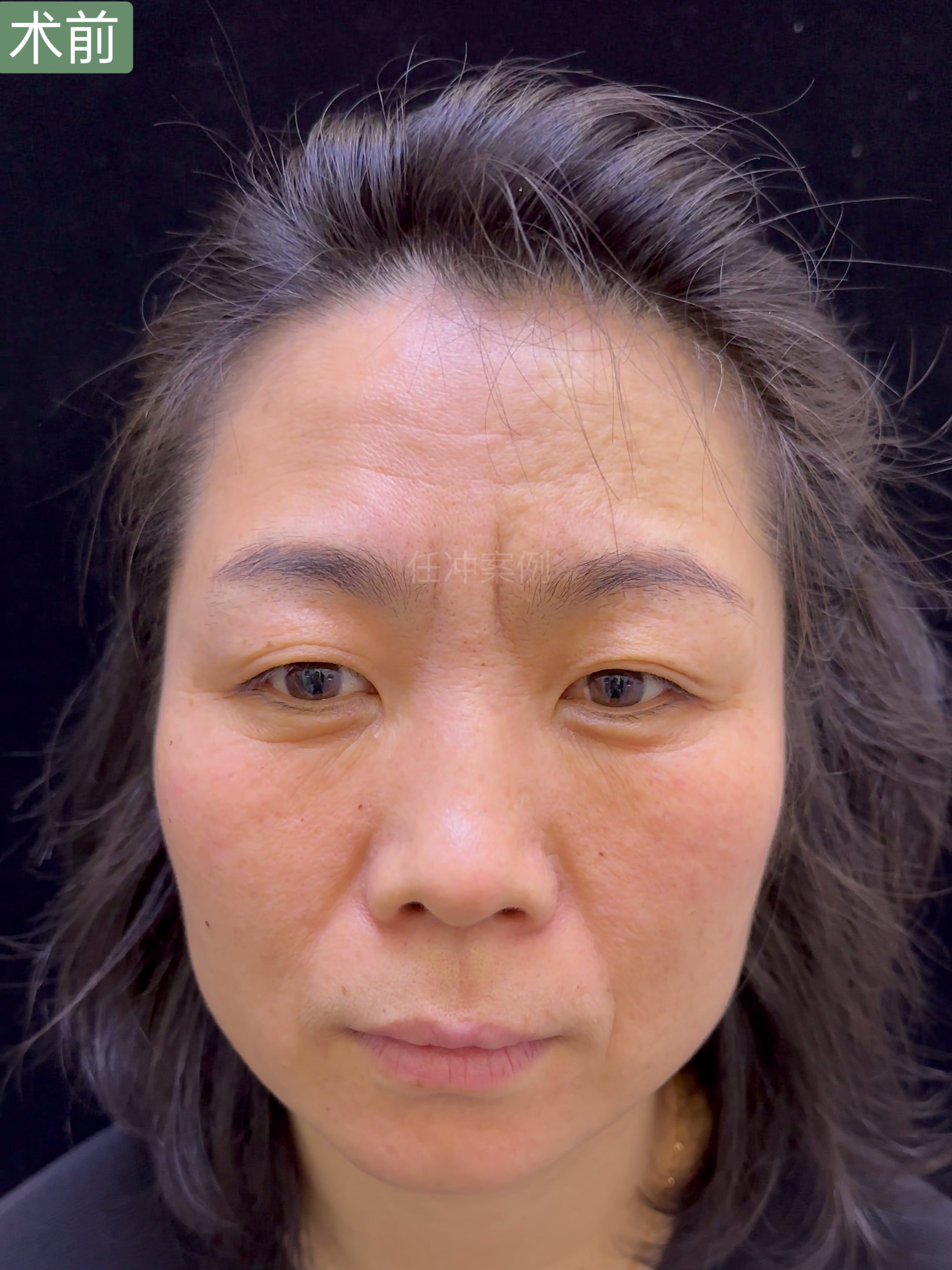 爱美之心人皆有之,川字纹切除后她说终于找回了自信,额头平了,状态