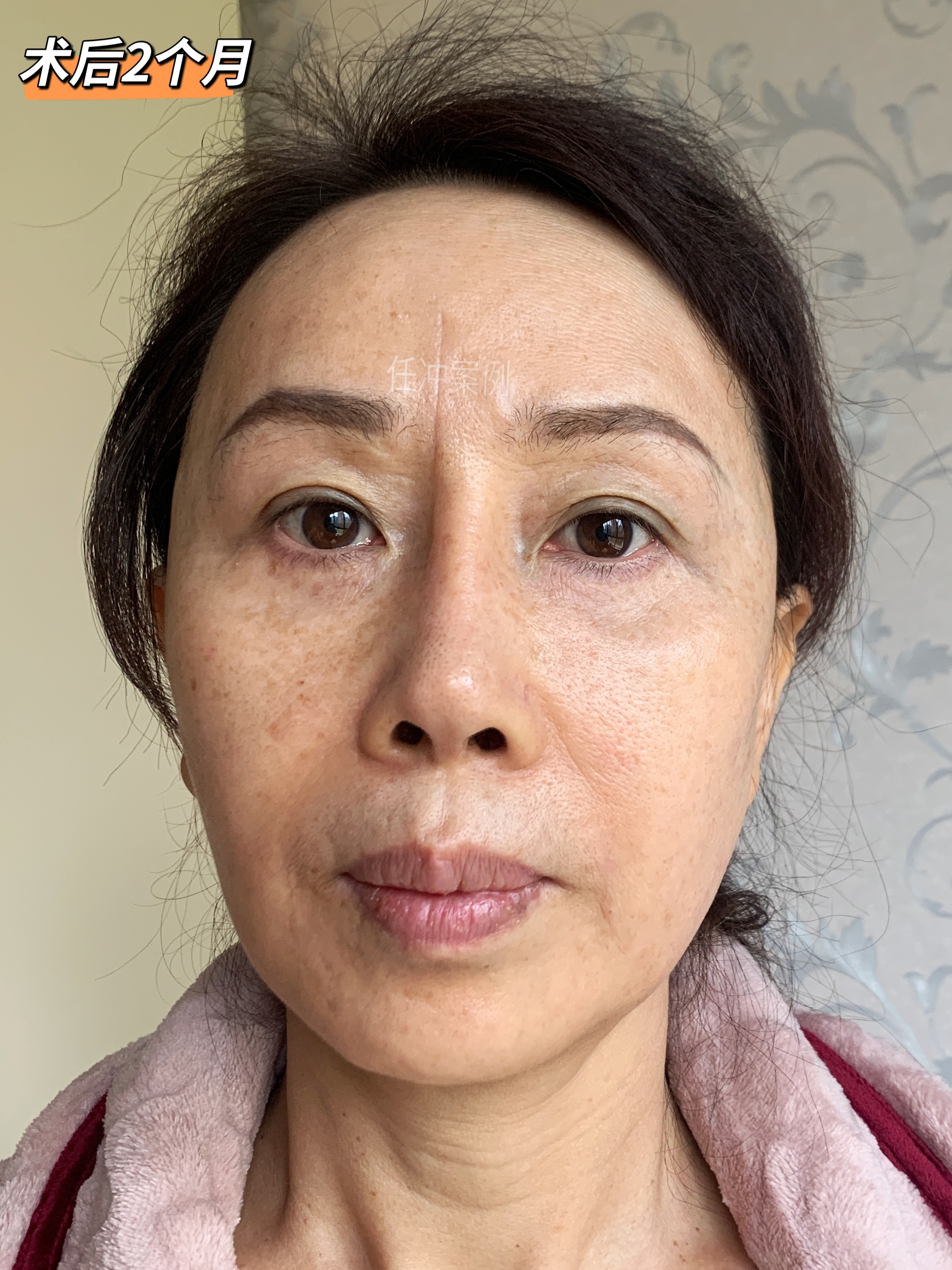 社交距离看不到痕迹  好多粉丝让我发一些川字纹切除后的远期照片