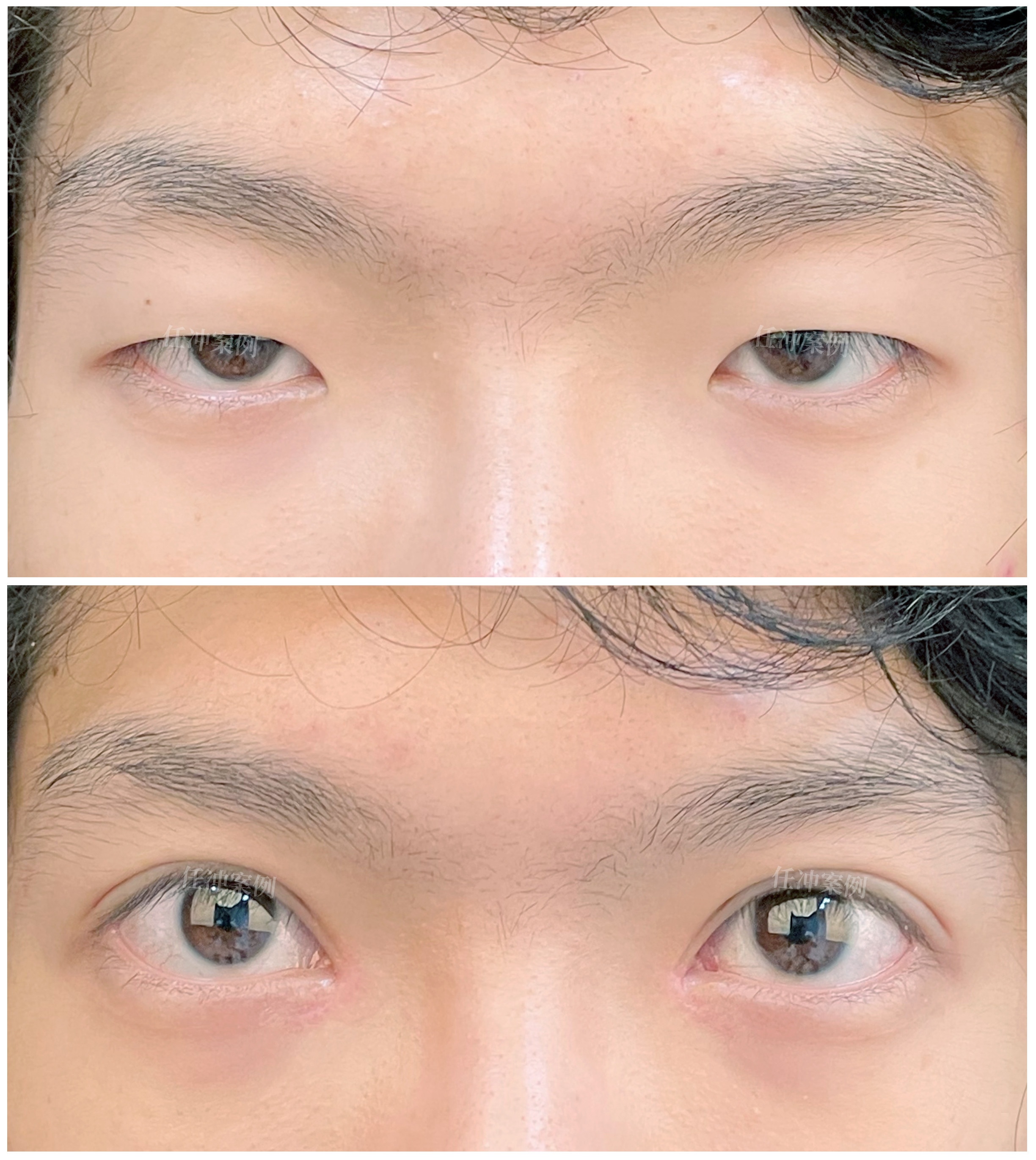 这个小伙子属于上睑下垂,上眼睑遮住了多半眼球,显得眼睛形态不好看