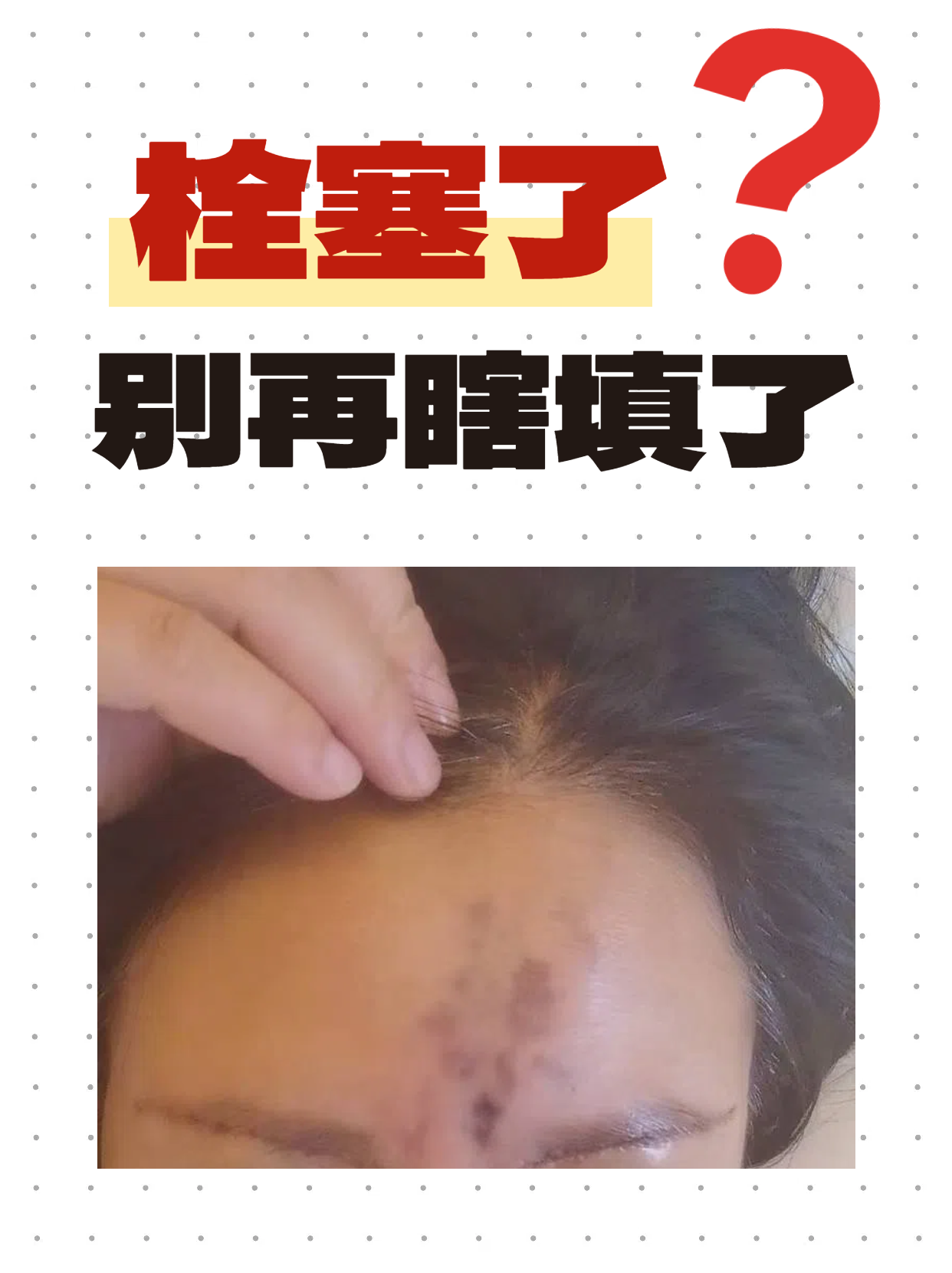 那什么是玻尿酸栓塞呢?