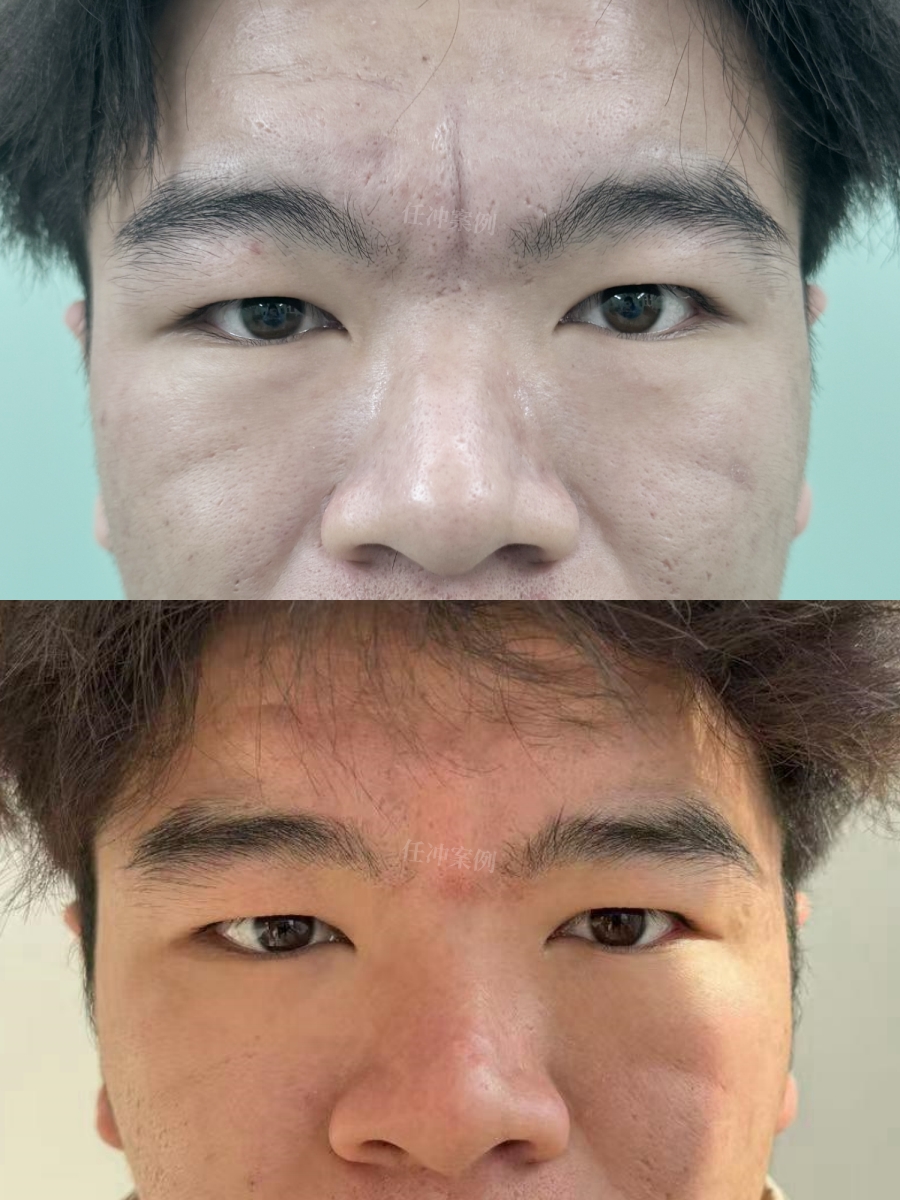 起来总是愁眉苦脸,仿佛老了好几岁男士川字纹对比图川字纹男士对比图