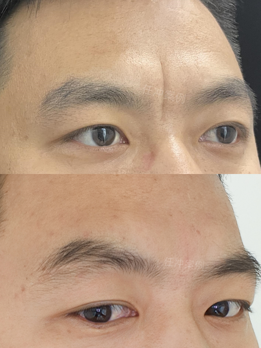 33岁,显凶的川字纹总算没了!