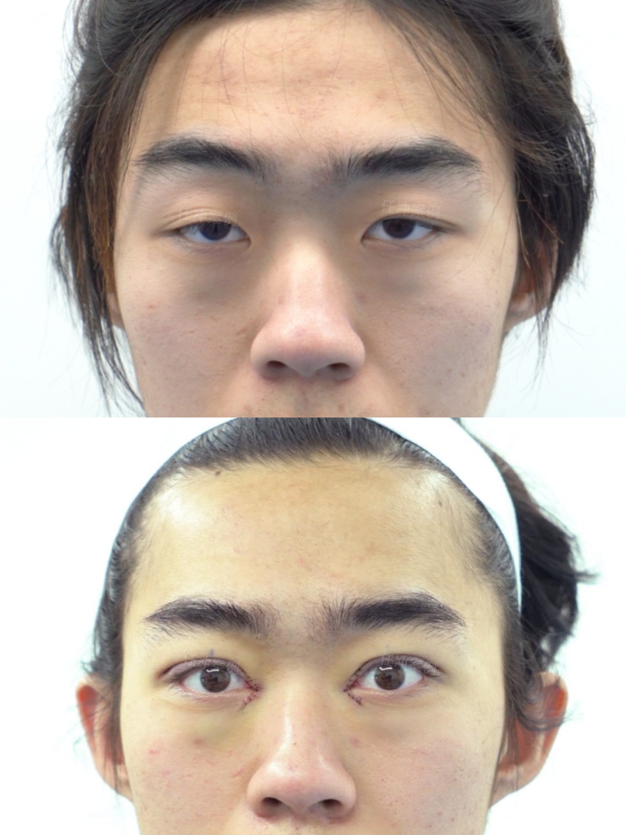 术前情况:单眼皮,中度上睑下垂,眼角有内眦赘皮 无法轻松睁大双眼