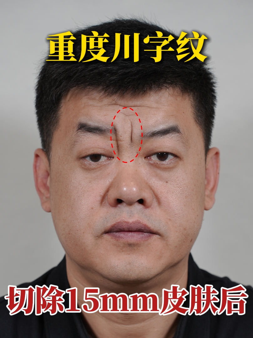 看看重度川字纹,切除15个毫米的皮肤后,是什么样子?