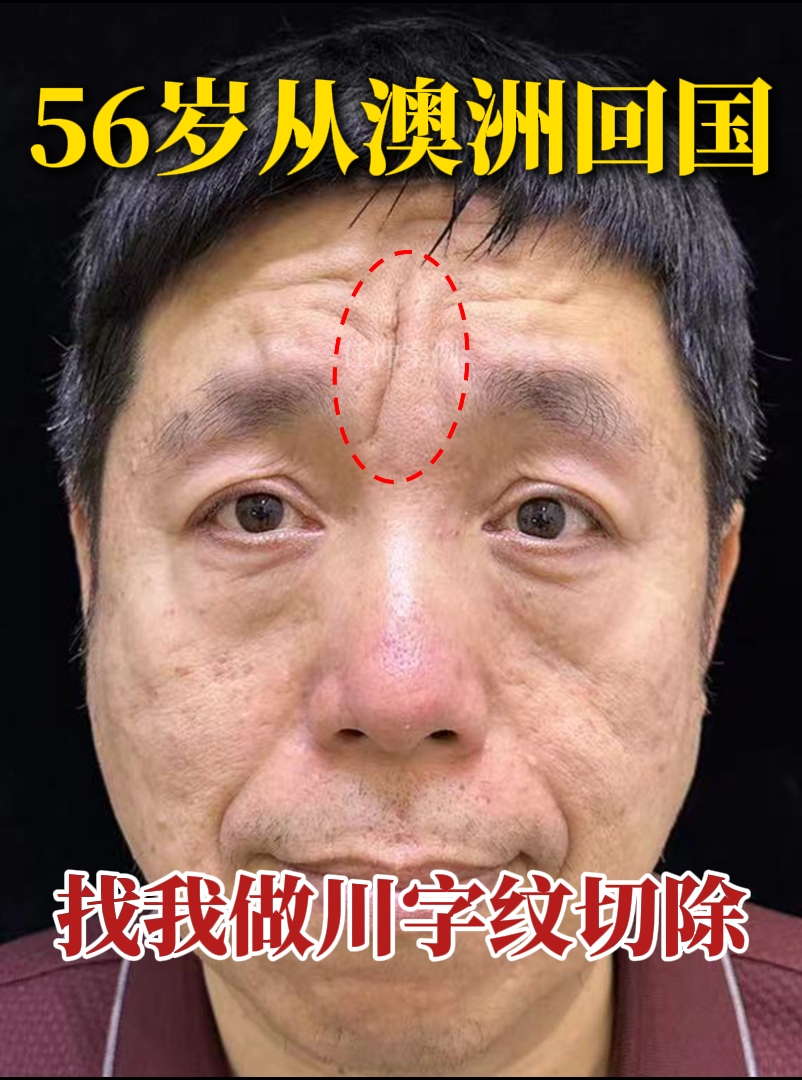 56岁,从澳洲回国找我做川字纹切除,手术即刻直呼:不敢相信!