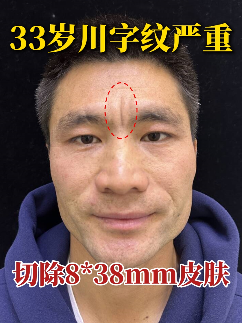 就养成了爱皱眉的习惯,再加上偏爱侧睡,久而久之就形成了严重的川字纹