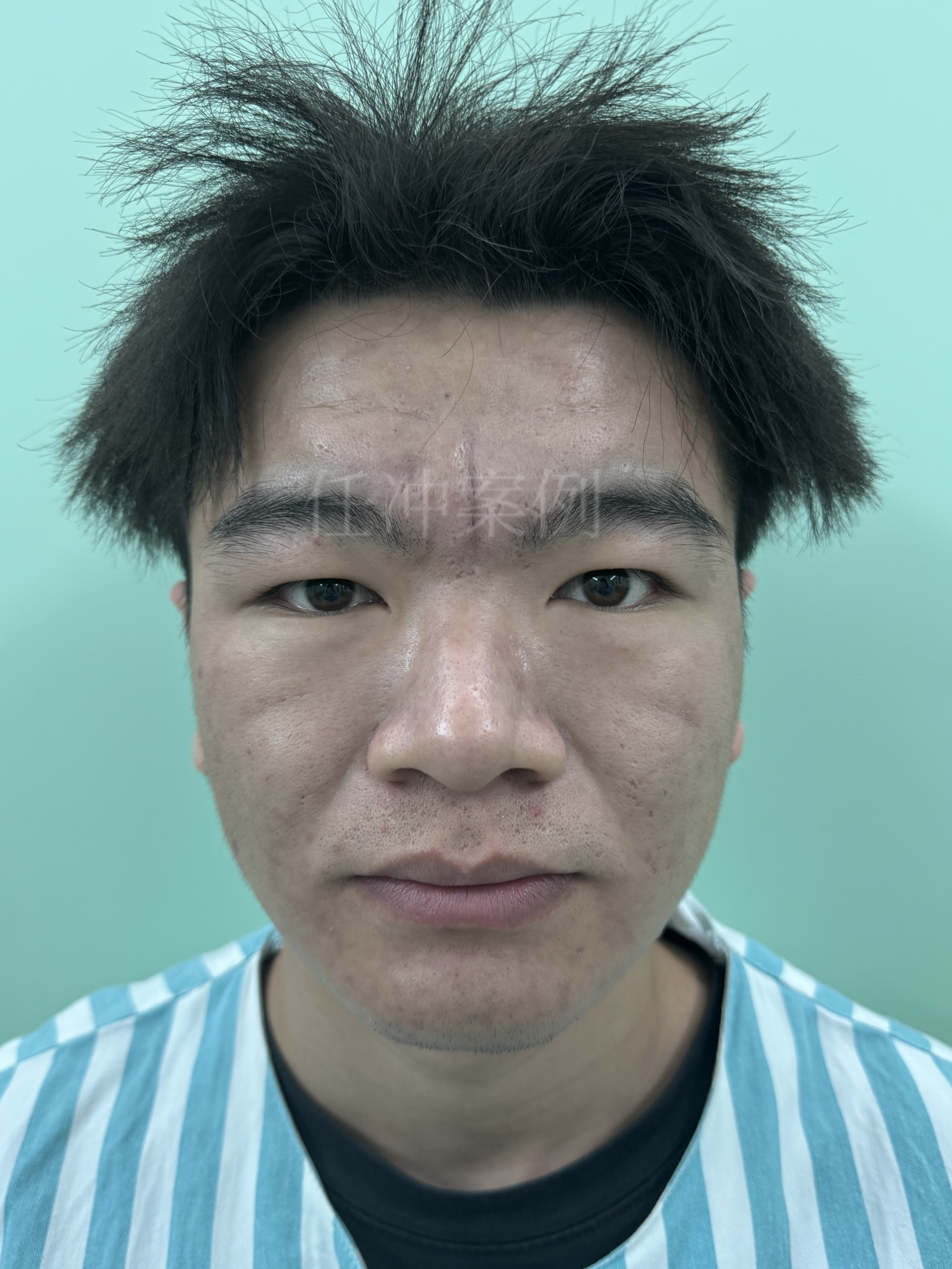 无美颜,无滤镜,原相机分享川字纹3个月的恢复情况!