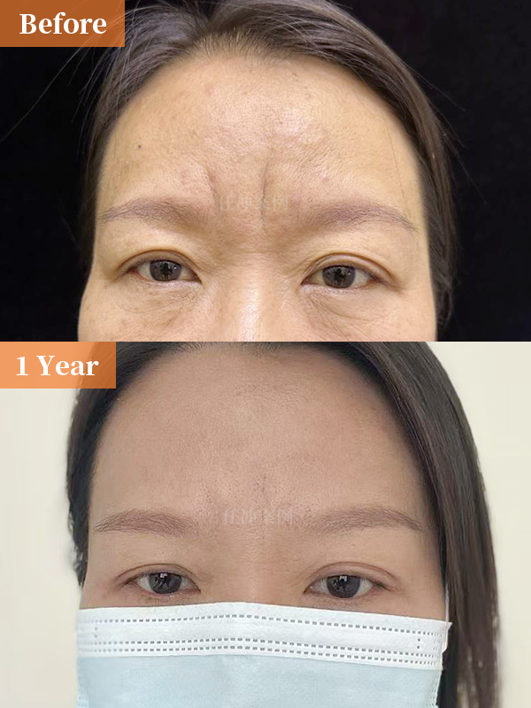 明明什么表情都没有,却因为眉头紧锁让人误会在生气,不开心,有烦心