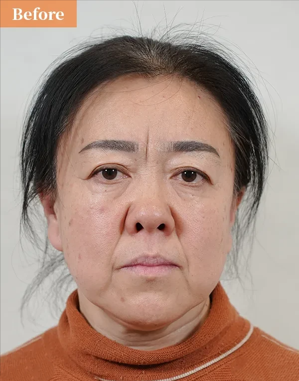 眉毛中间有悬针纹好不好悬针纹女人面相的寿命眉心有竖状伤疤的人