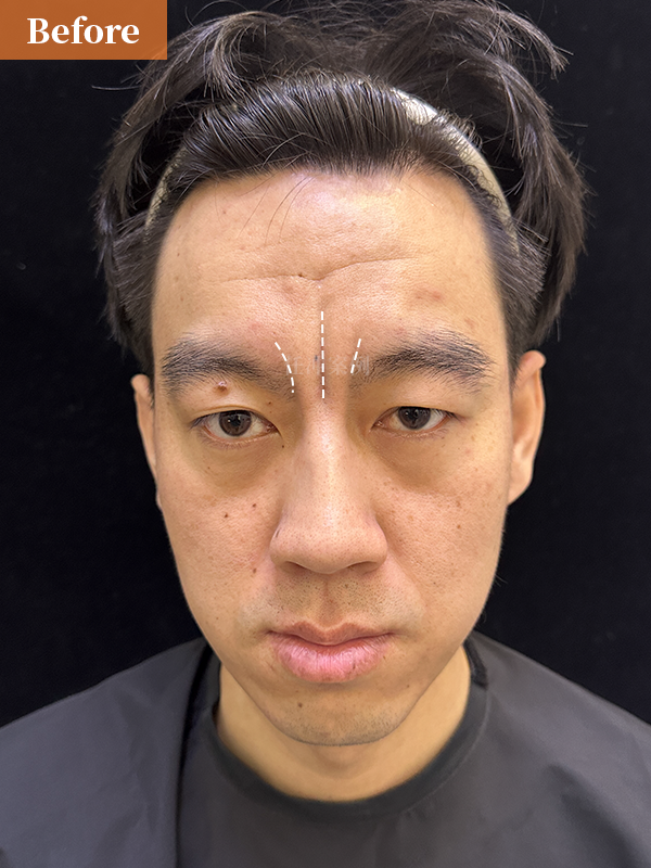 33岁北京小伙儿,川字纹切除术后8个月效果反馈,无美颜,无滤镜实拍!