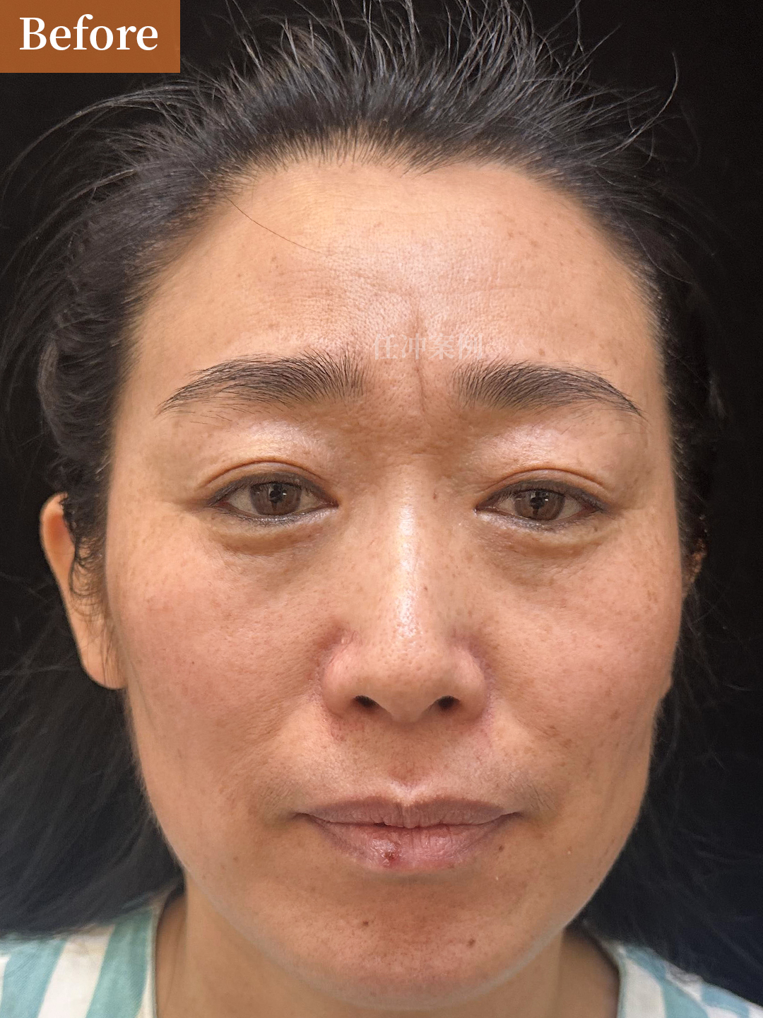 每次一照镜子,第一眼 眼下皱纹很深的川字纹川字纹切除