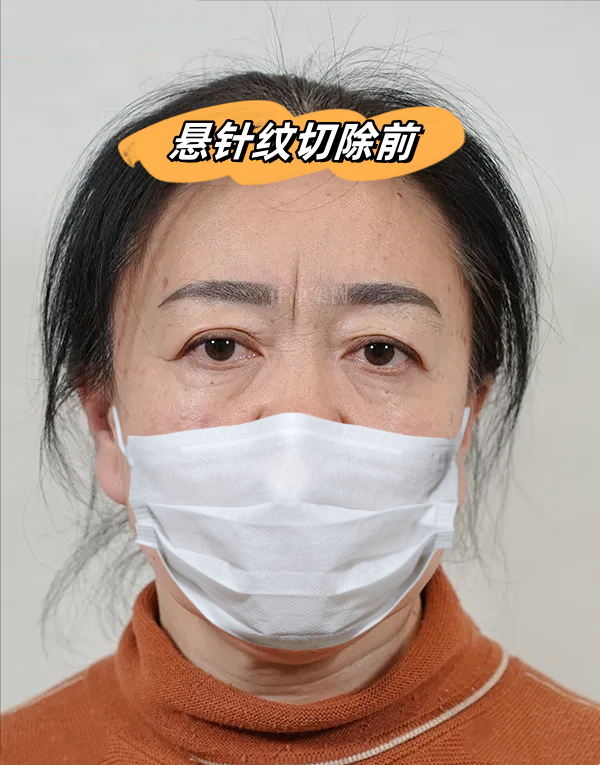 在中医理论中,印堂悬针纹被认为是一种病症表现,可能与身体的状况有关