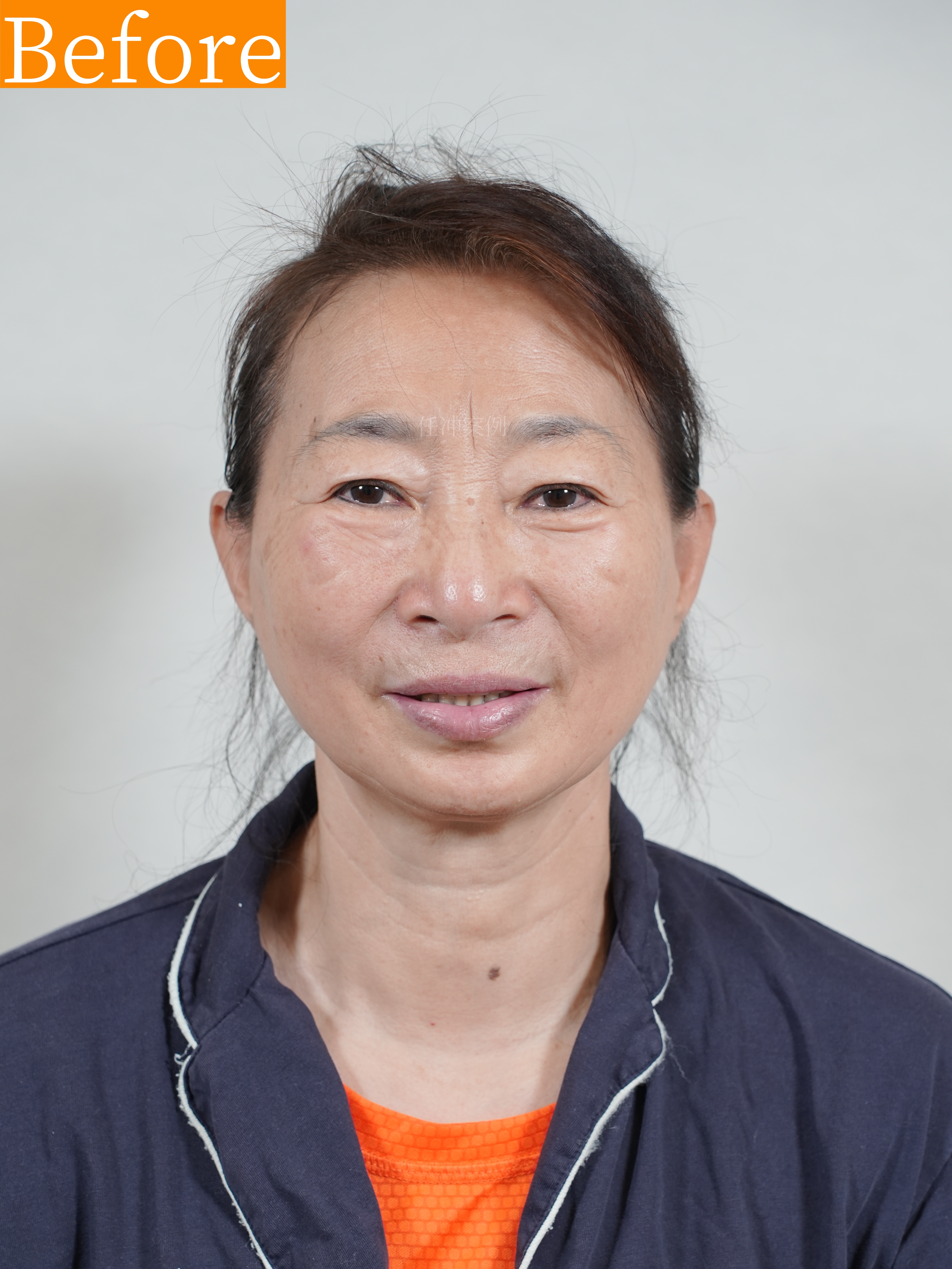 63岁广场舞教练川字纹切除后,重现年轻光彩,对比惊人!