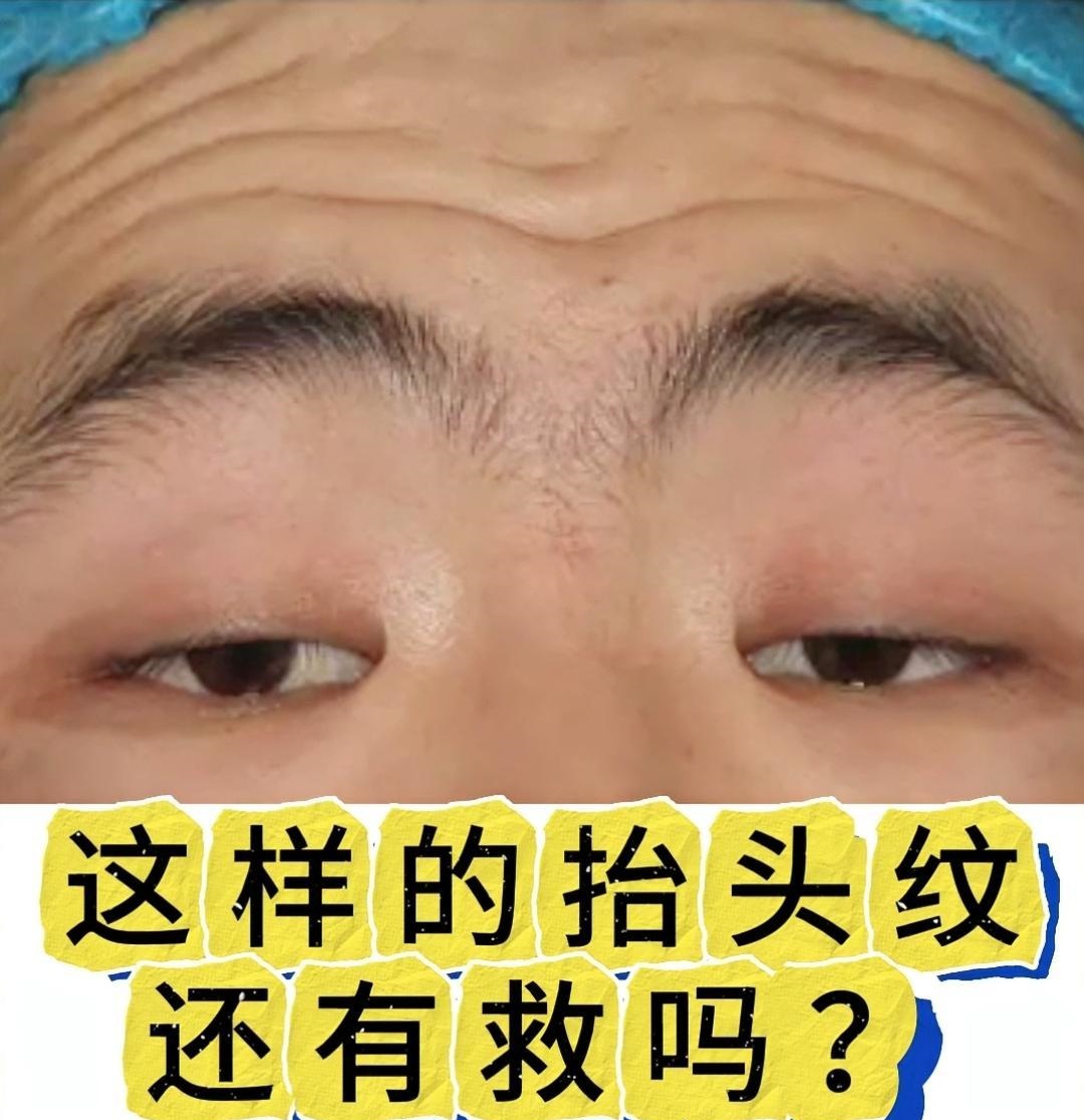 有求美者发来照片,这样的抬头纹还有救吗?