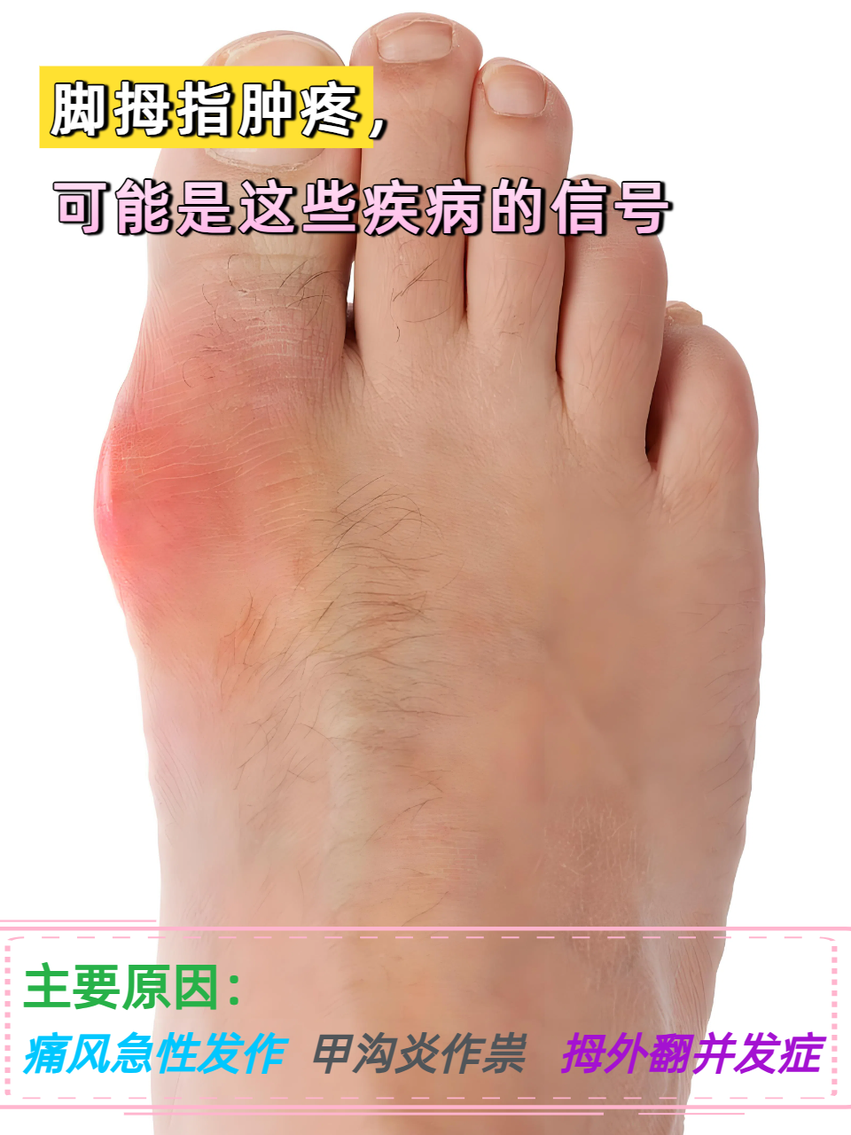 脚拇趾肿疼,可能是这些疾病的信号