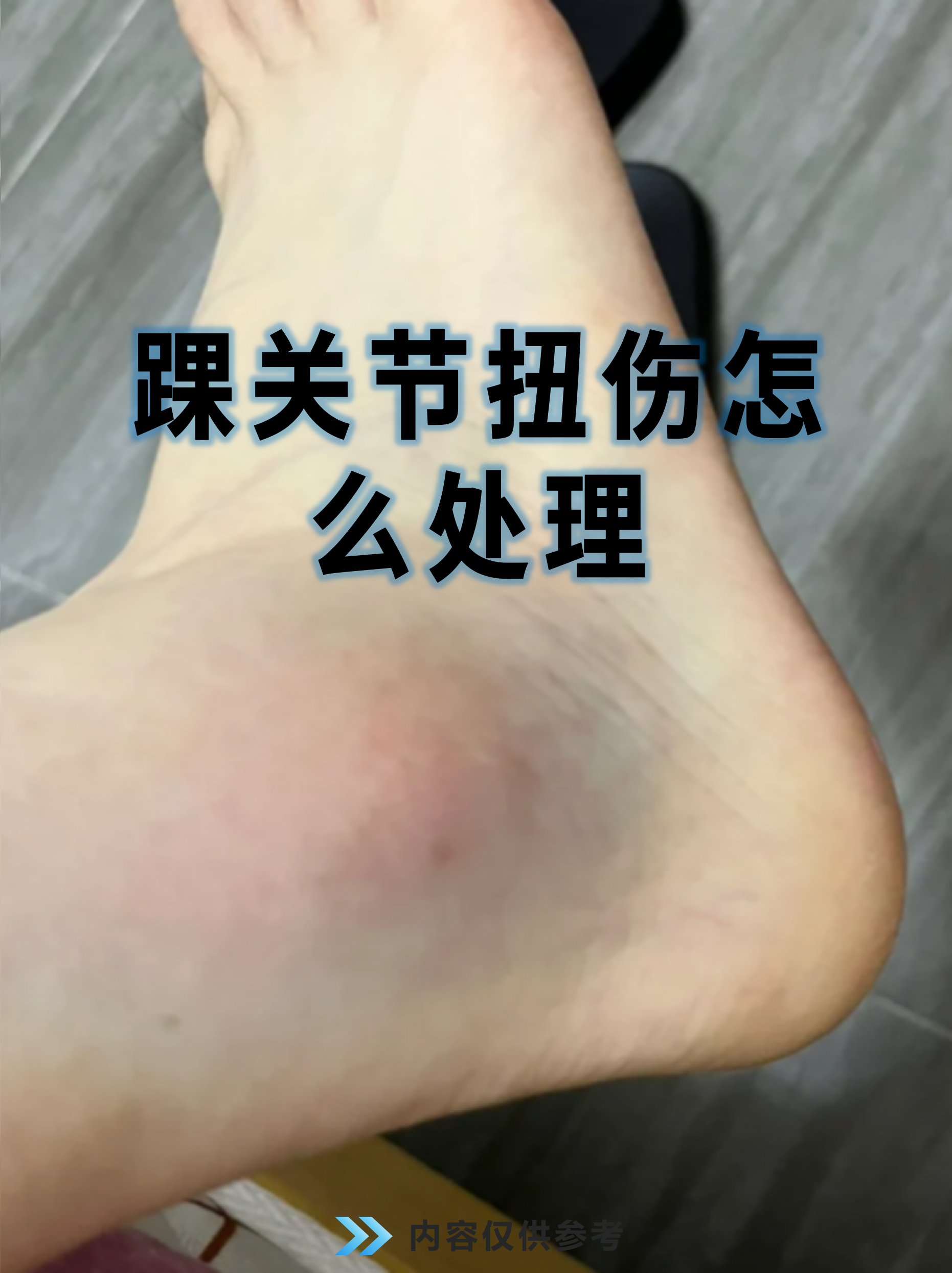踝关节扭伤怎么处理