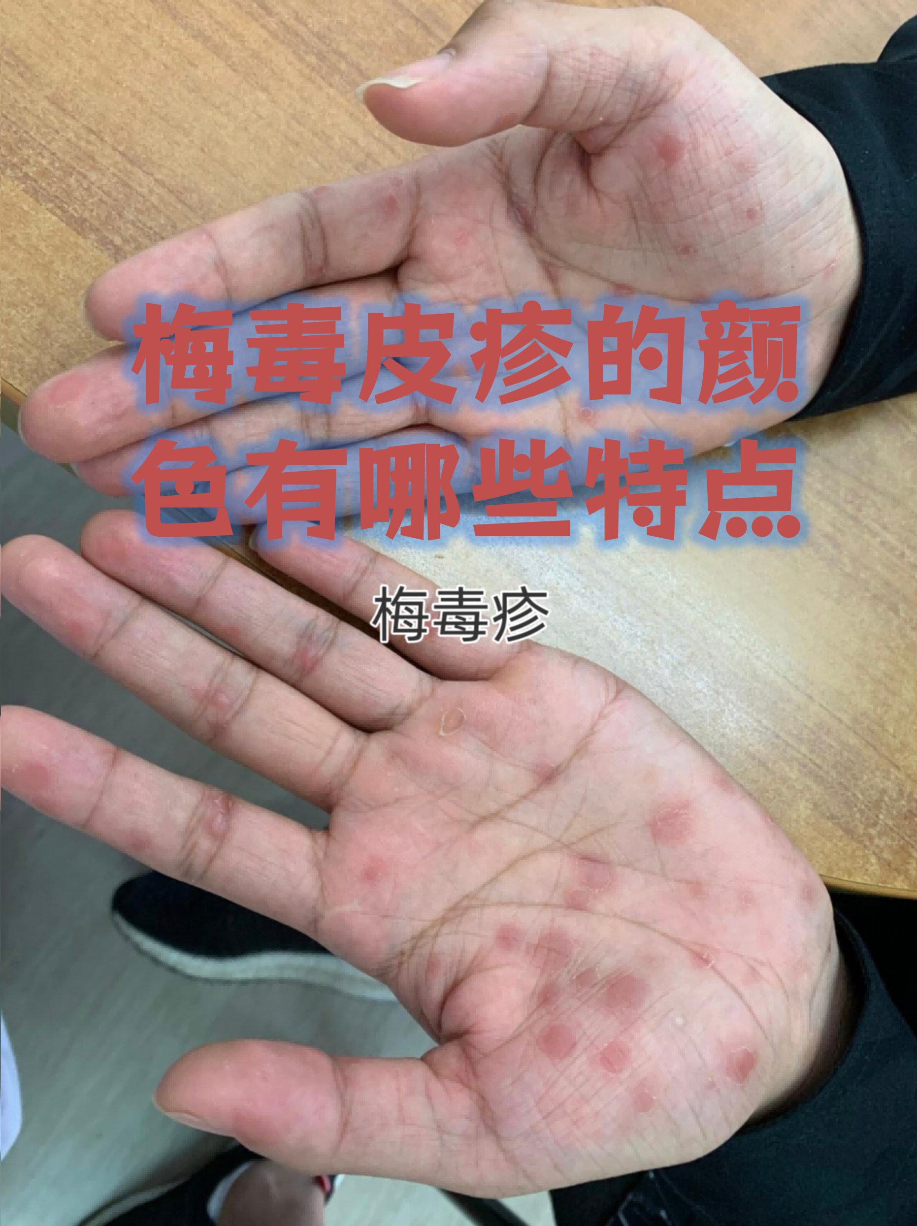 梅毒皮疹的颜色有哪些特点