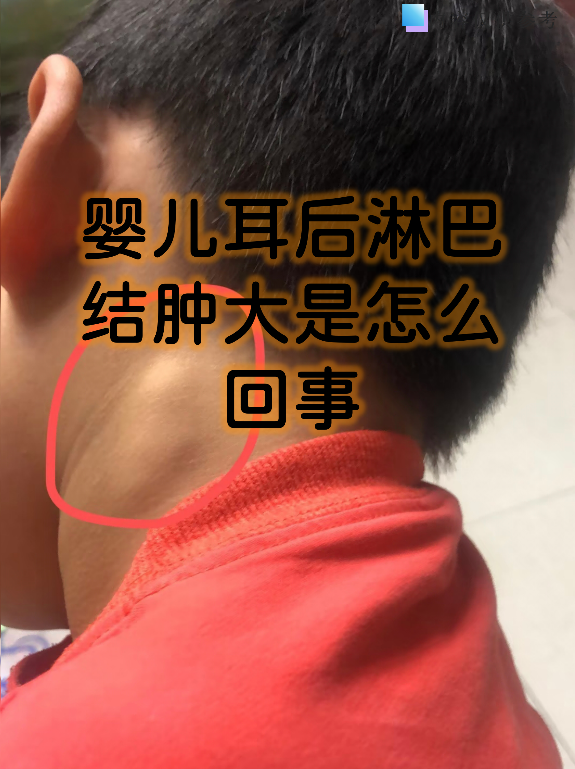 婴儿耳后淋巴结肿大是怎么回事