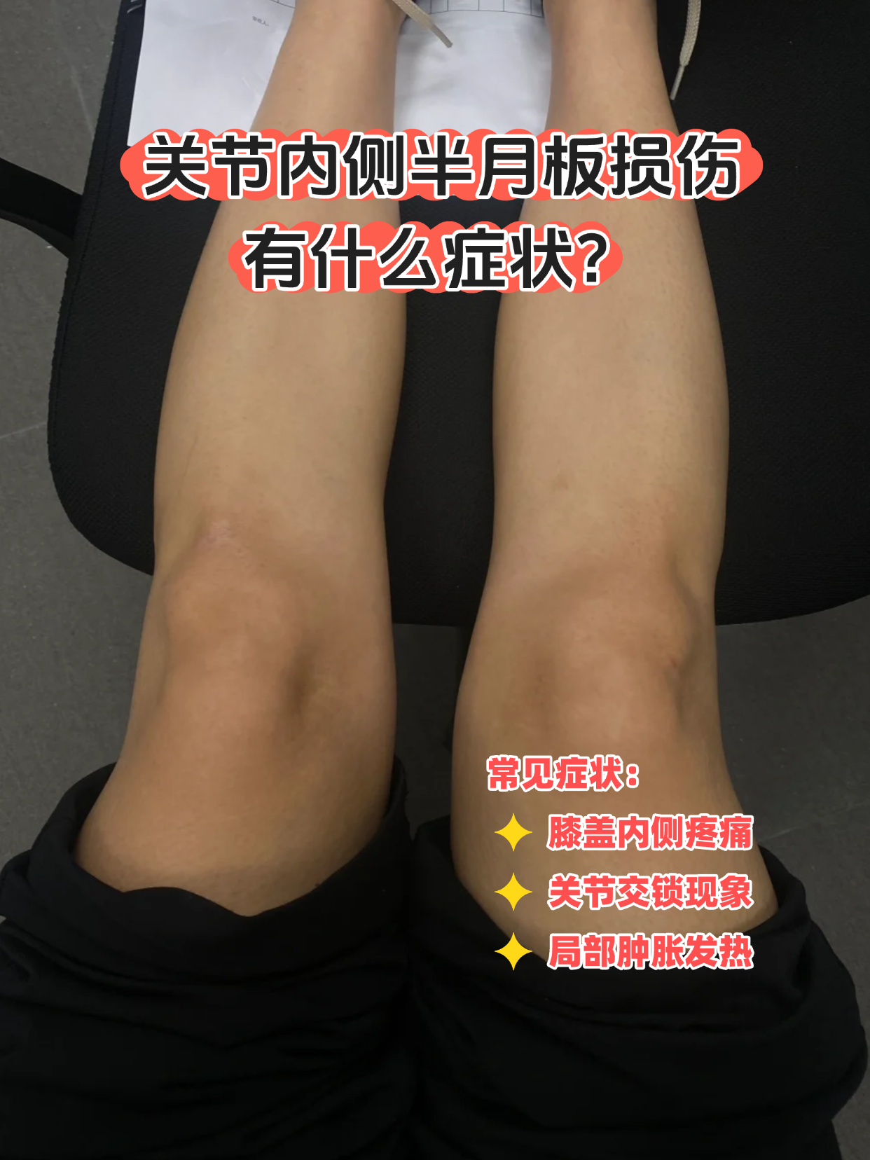 关节内侧半月板损伤悄悄影响着膝关节的灵活度