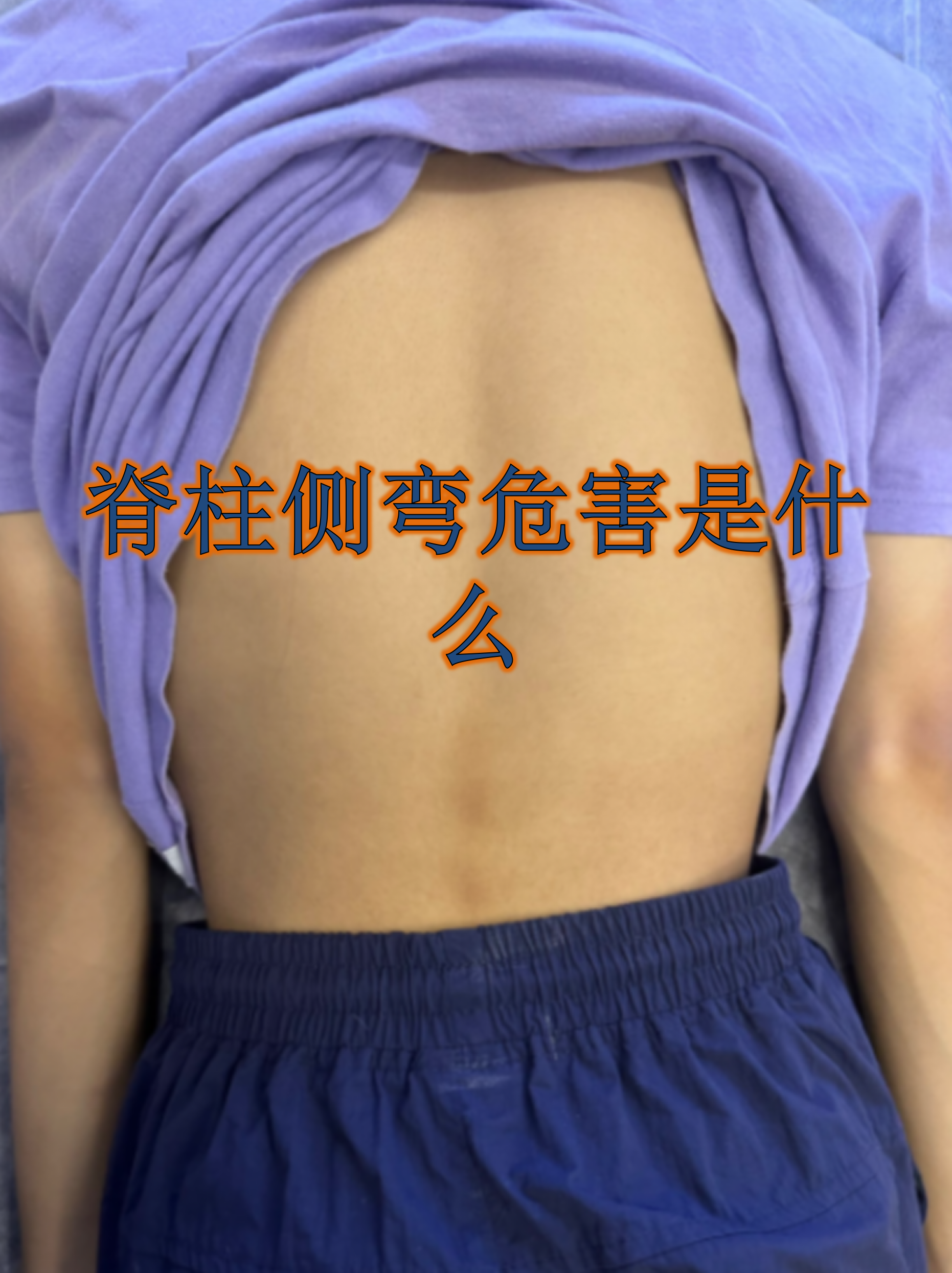 脊柱侧弯看似只是体态问题,但它的危害可能远超