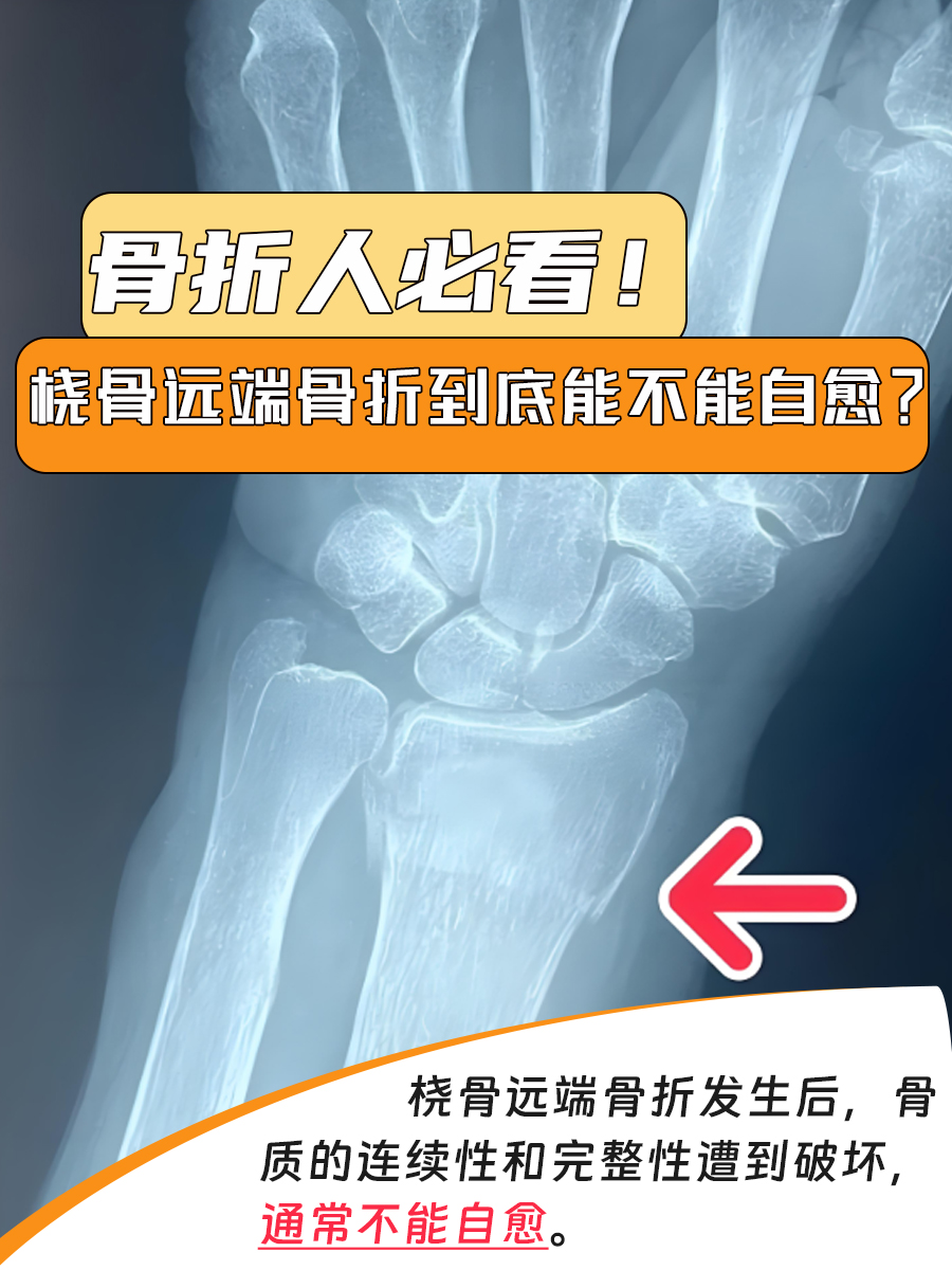 这种骨折通常发生在桡骨远端的2