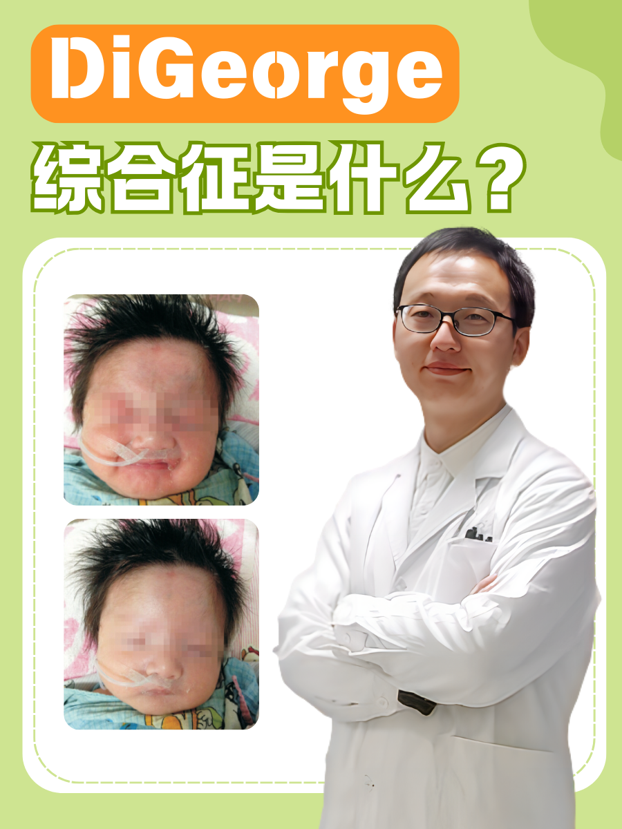 digeorge综合征是什么?