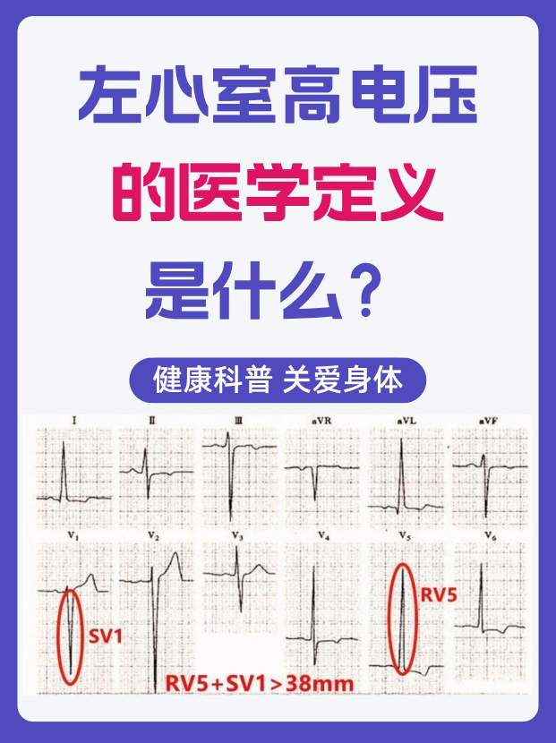 心电图电压图片