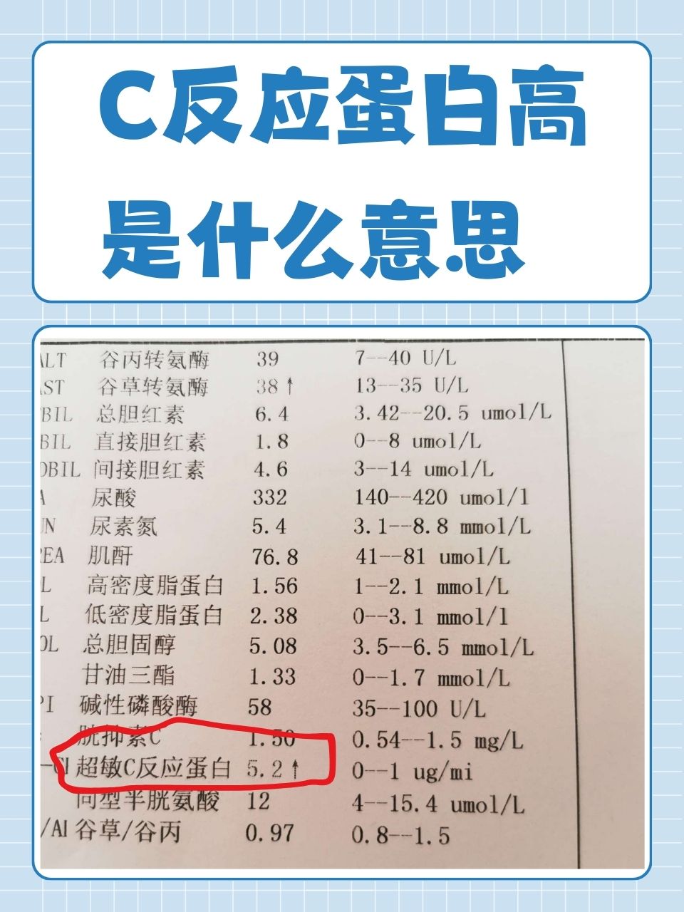在体检报告或医疗检查中,我们可能会看到"c反应蛋白高"这样的结果