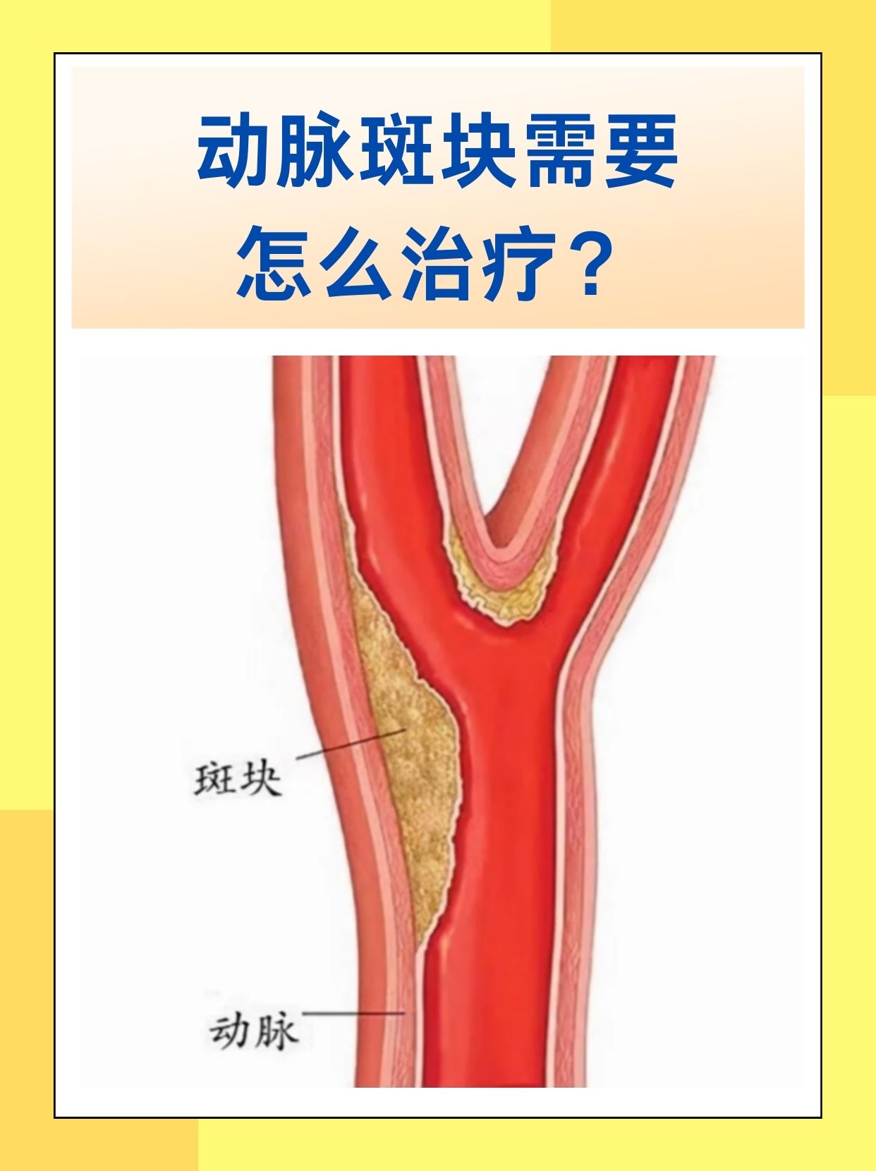 那么动脉斑块需要怎么治疗呢?下面我们一起来了解有效的治疗方法