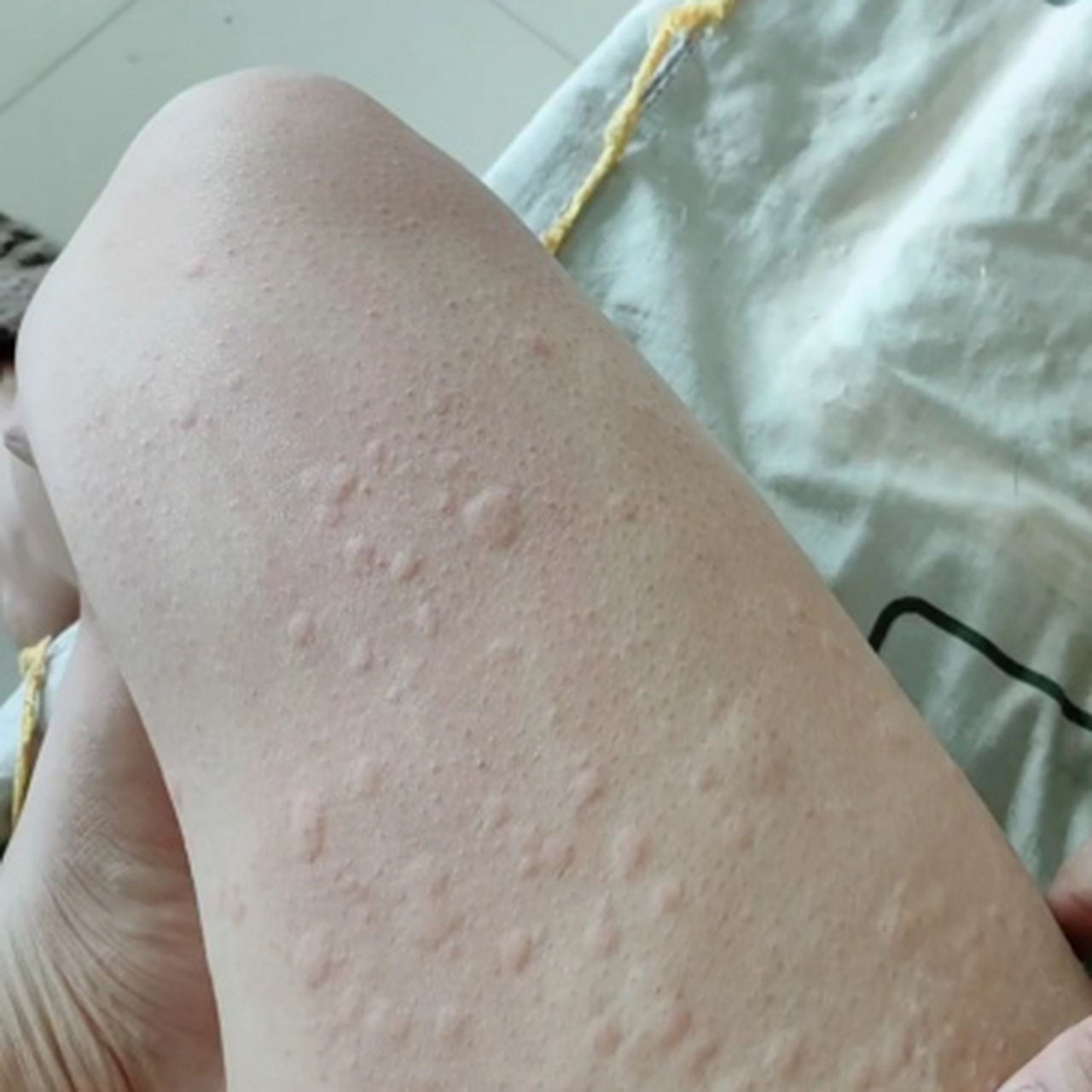 各位,我身上突然起了些疙瘩,这是咋回事儿啊?有啥办法能治治不?