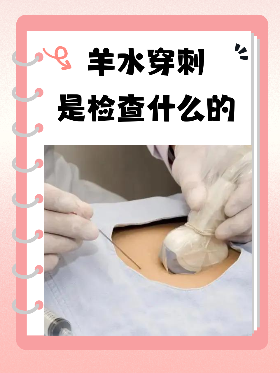 羊水穿刺是检查什么的  羊水穿刺又称为羊膜腔穿刺术,是产前诊断中一