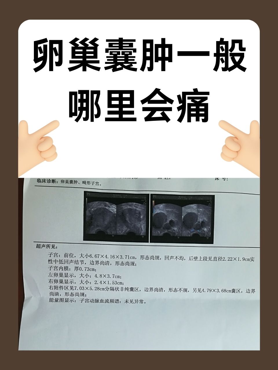 卵巢囊肿一般哪里会痛