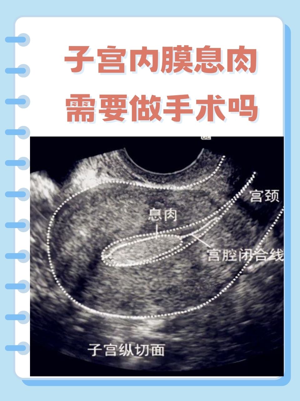 子宫内膜息肉怎样根治图片