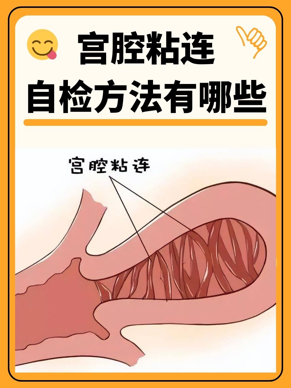 宫腔粘连自检方法有哪些  在女性的健康中,宫腔粘连是一个不容忽视的