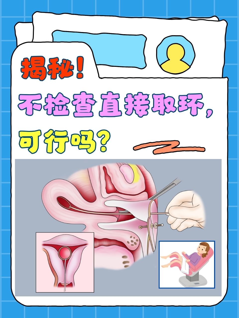 原理动画取环过程图取环疼吗女性取环节育环可以终身不取吗打阴环取吉