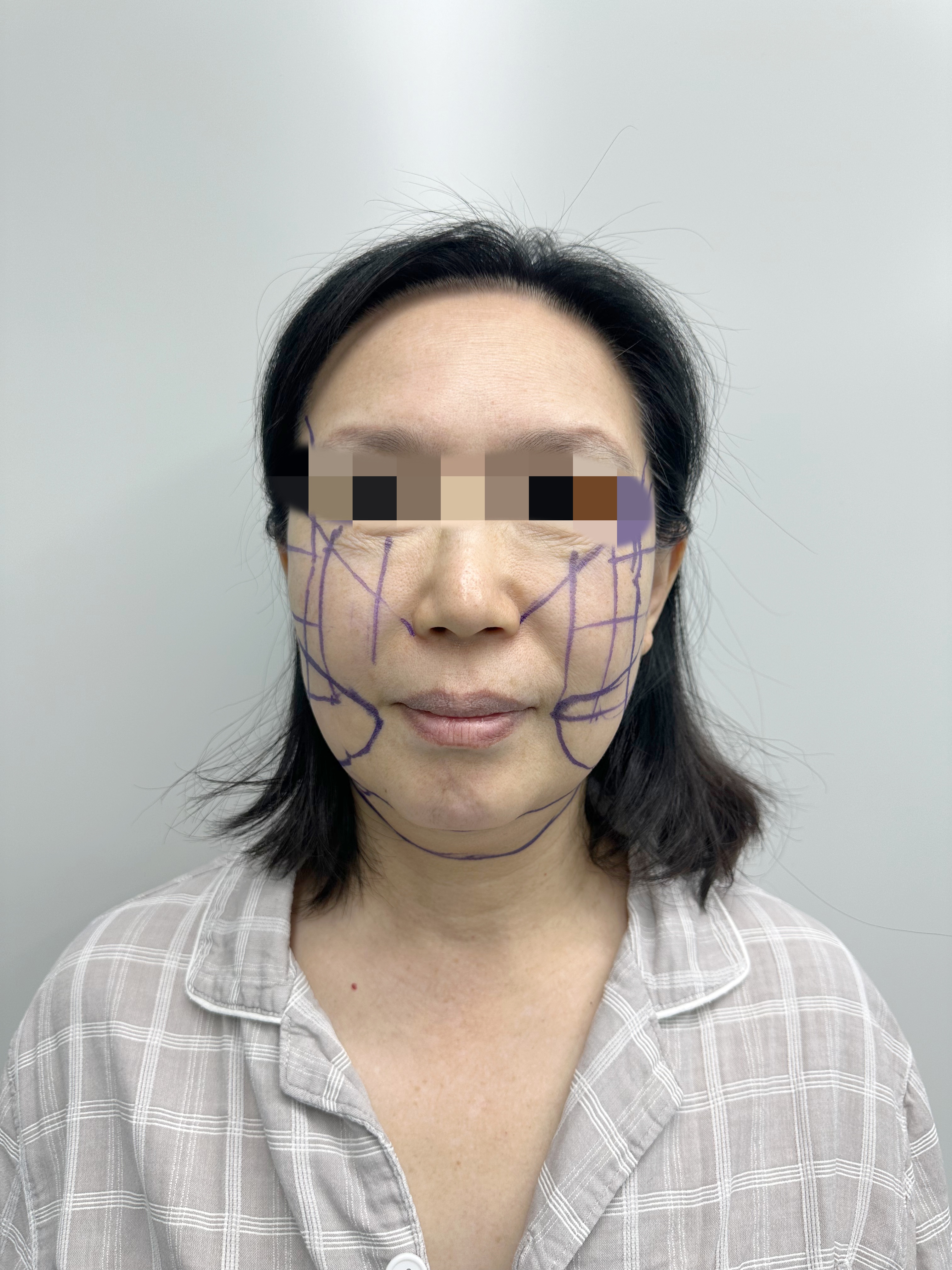 拉皮术前画线具有多方面重要意义