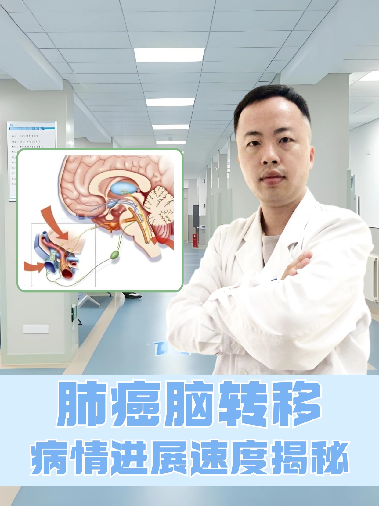 放疗吗肺癌转移脑瘤小细胞肺癌脑转移什么是脑膜转移肺癌转移头部肺癌