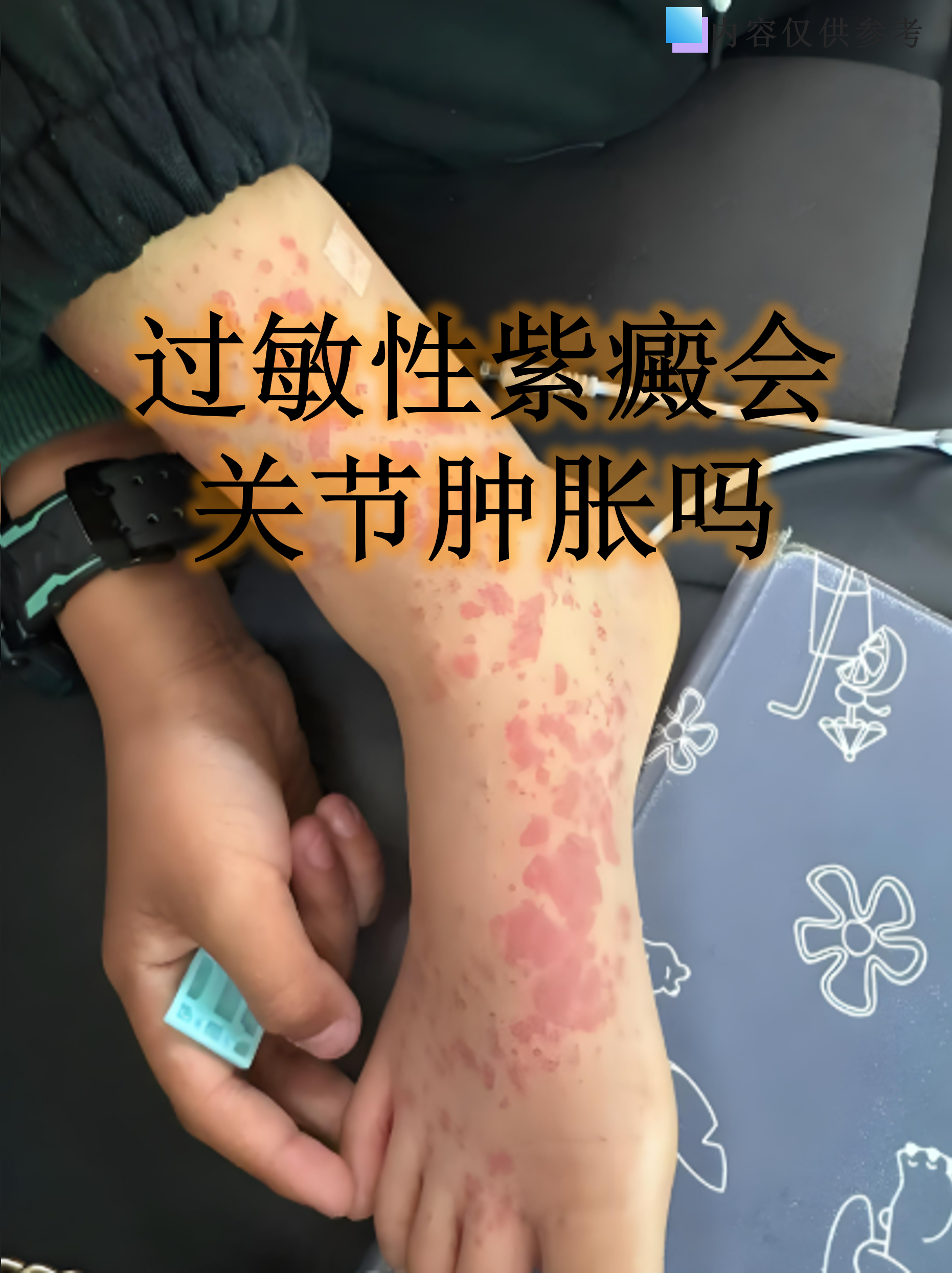 过敏性紫癜会关节肿胀吗
