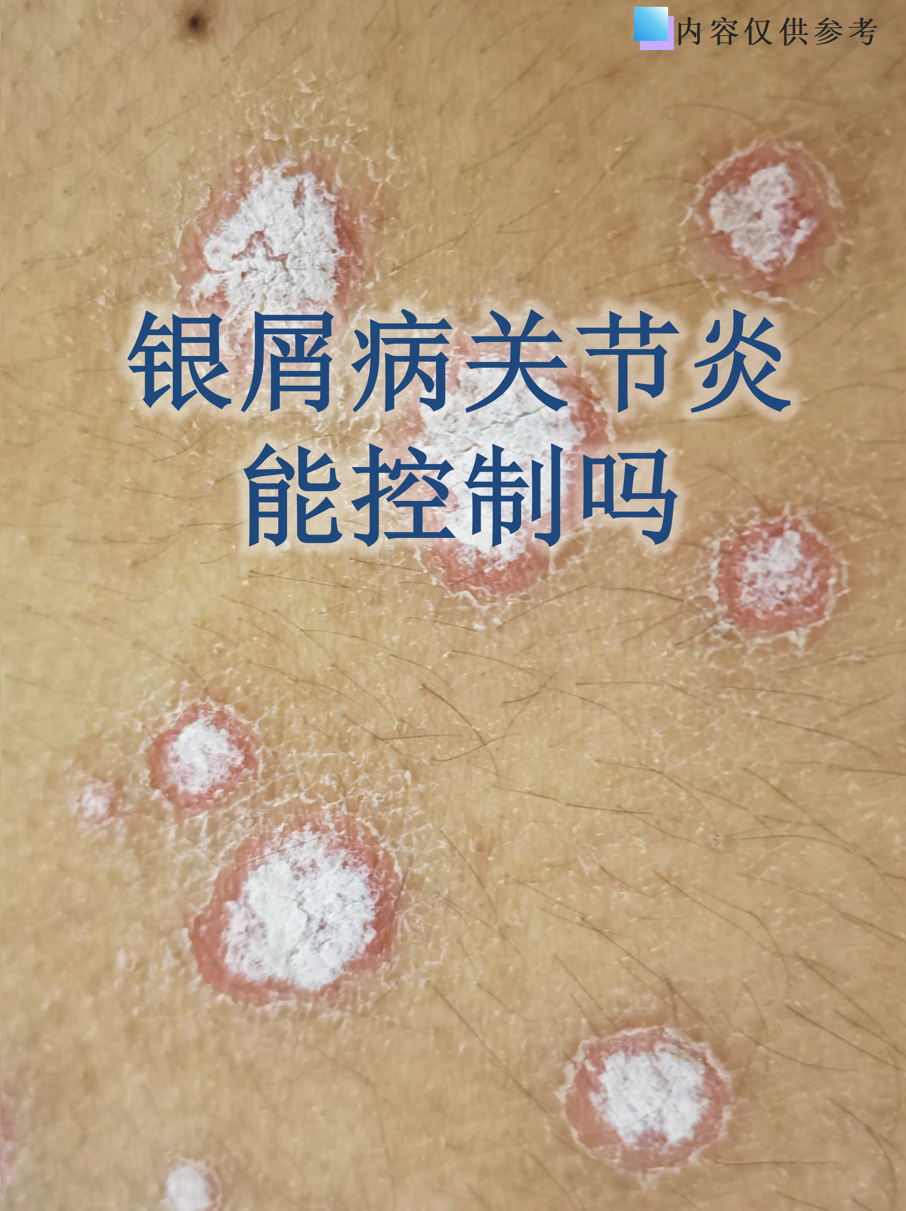 银屑病关节炎能控制吗