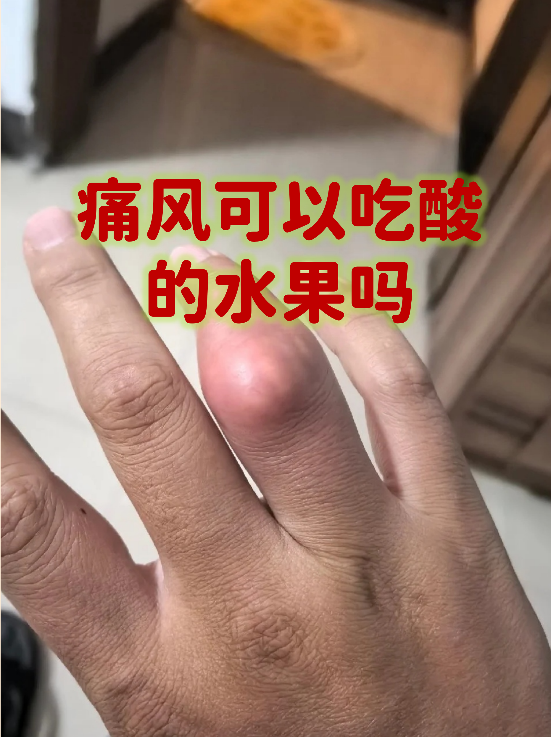 痛风可以吃酸的水果吗