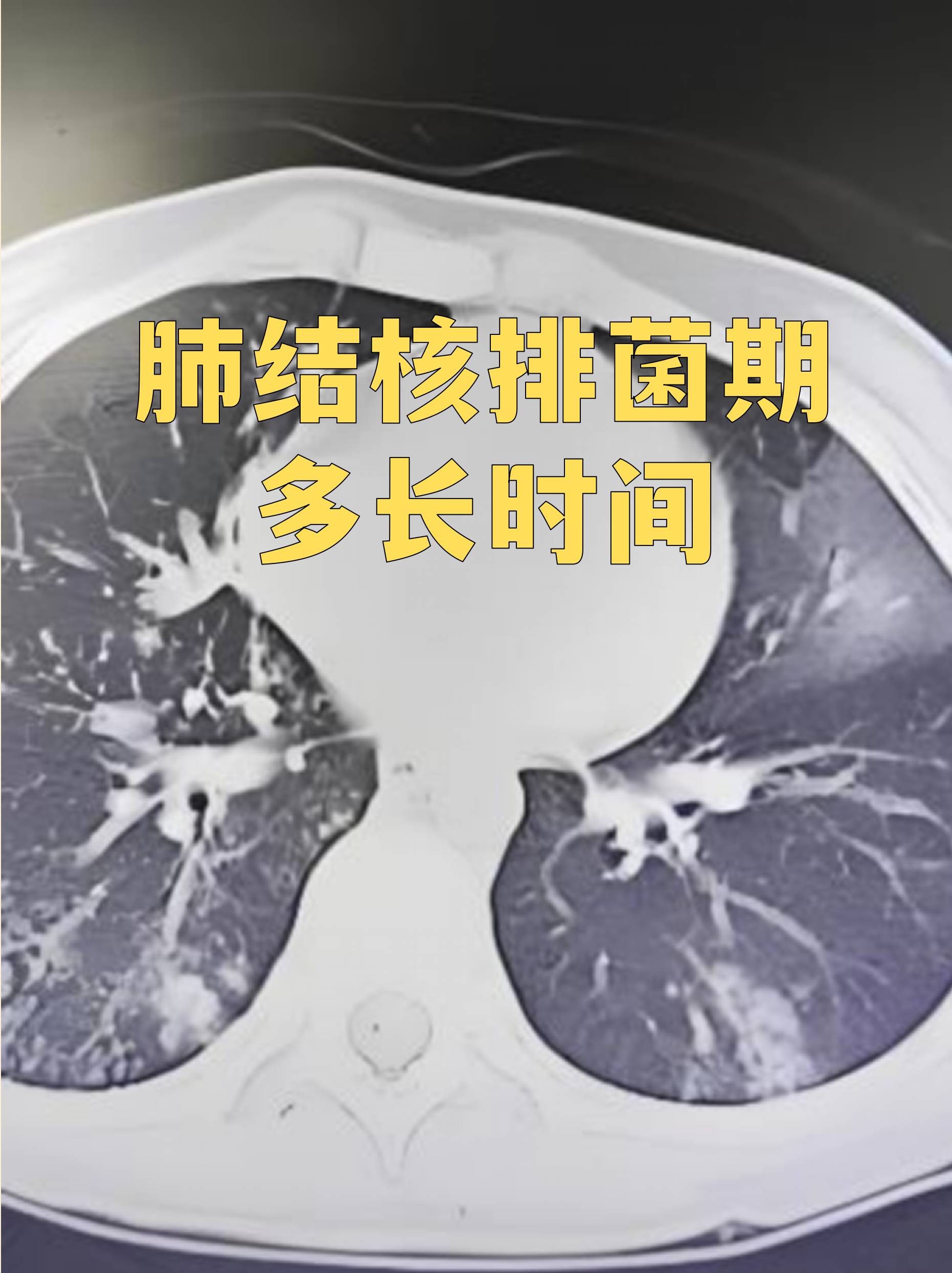 肺结核排菌期多长时间