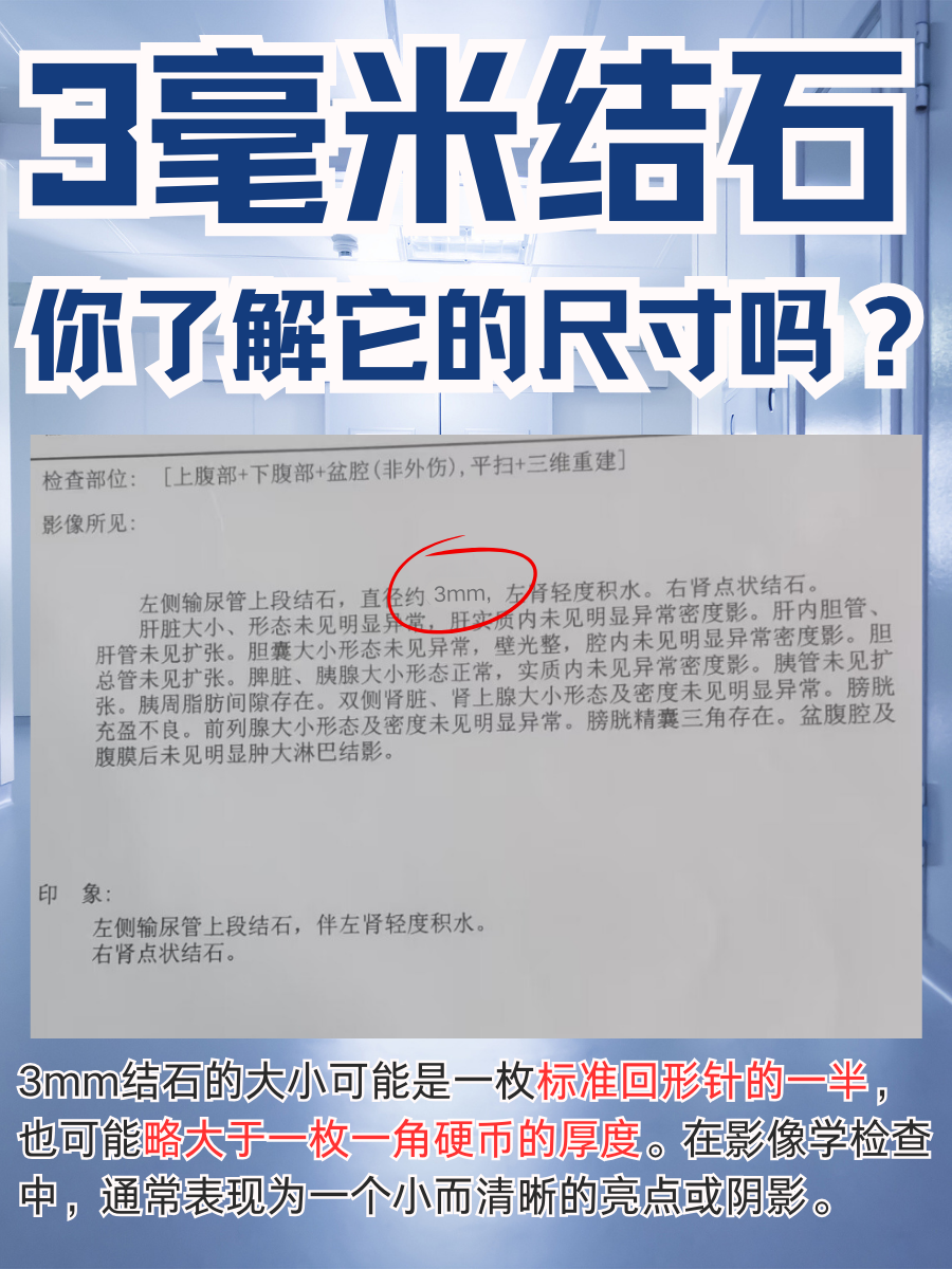3毫米结石,你了解它的尺寸吗?
